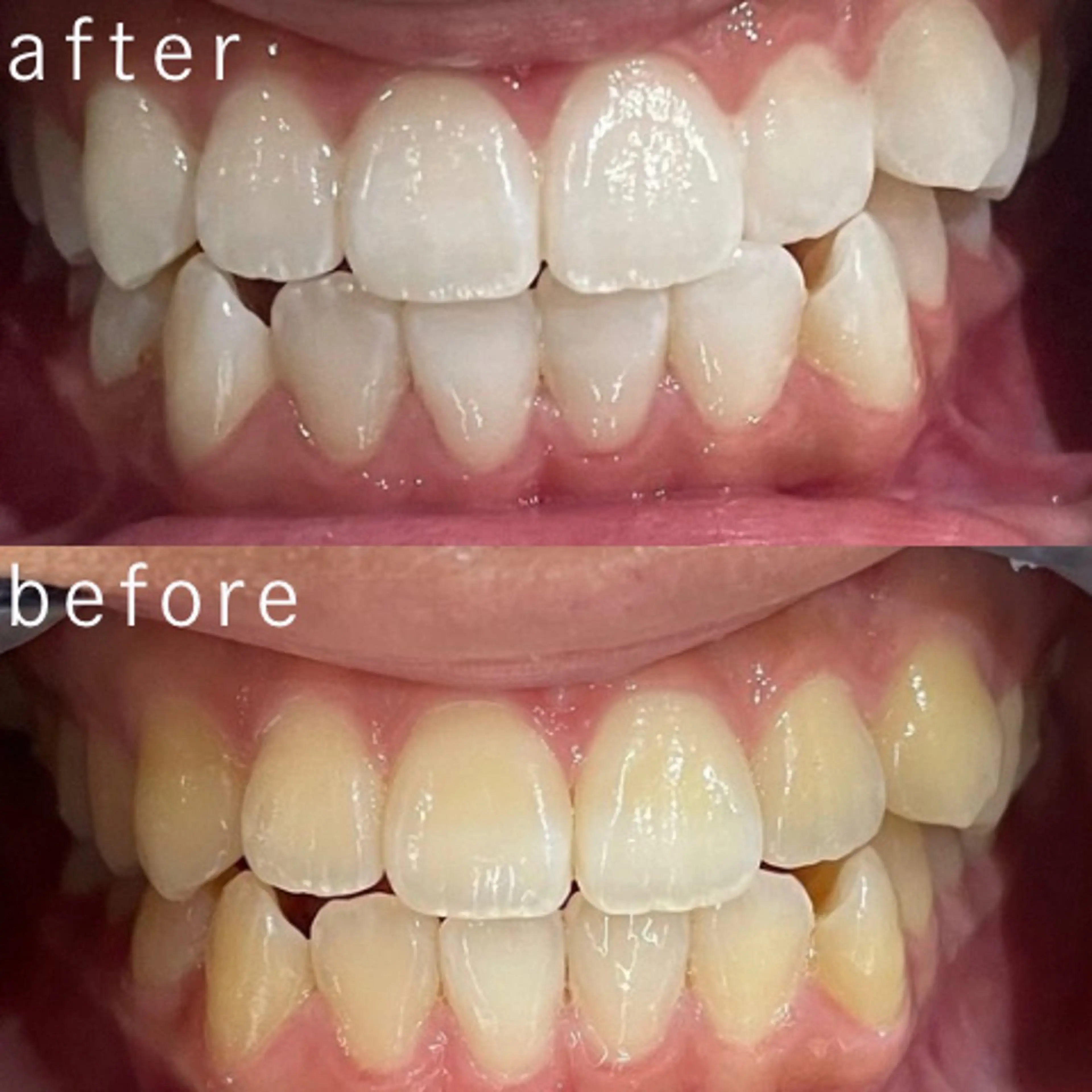 その他 セルフホワイトニング 都立大学🦷✴︎のその他イメージ