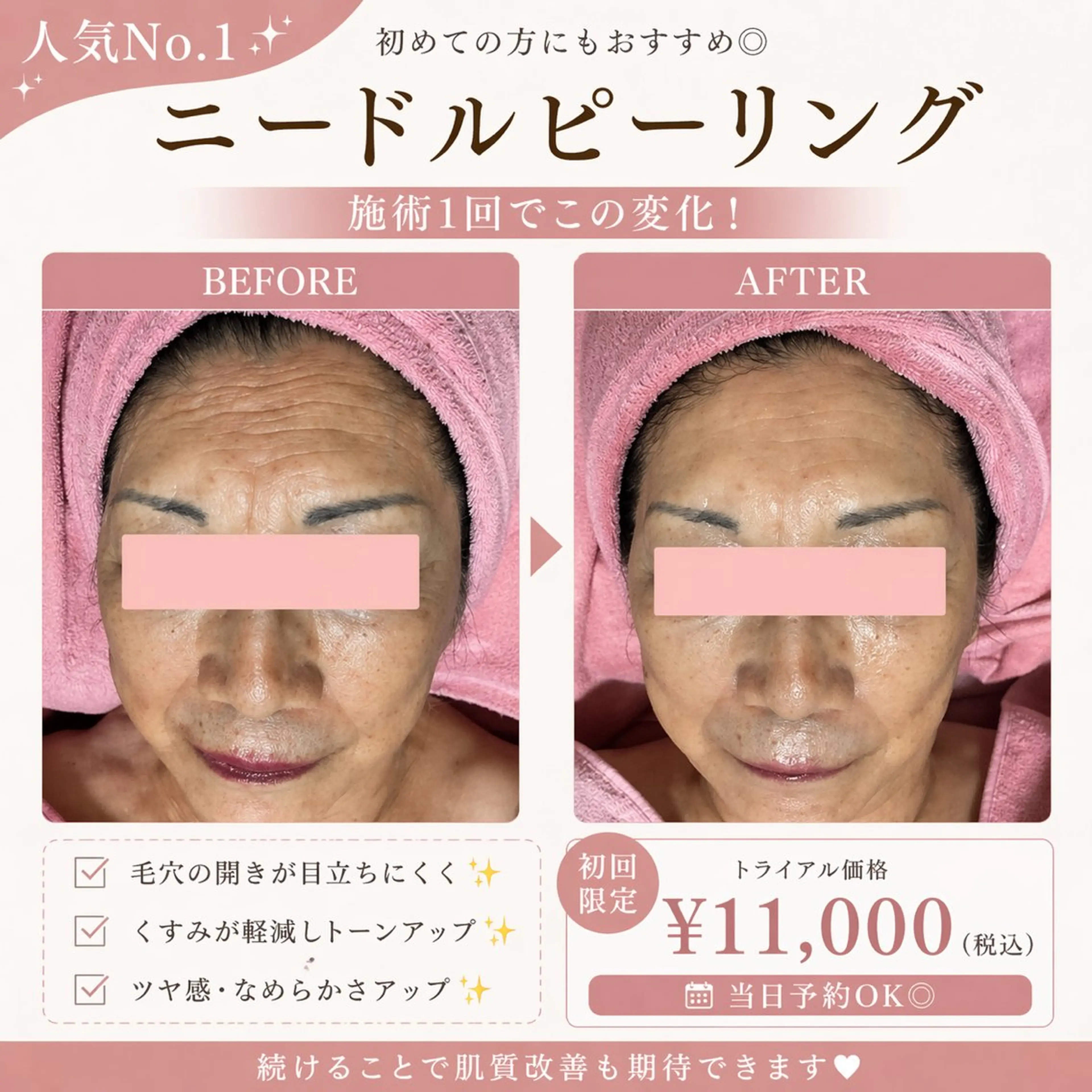 エステ ピーリングケア 🤍moekoのエステ・リラクイメージ