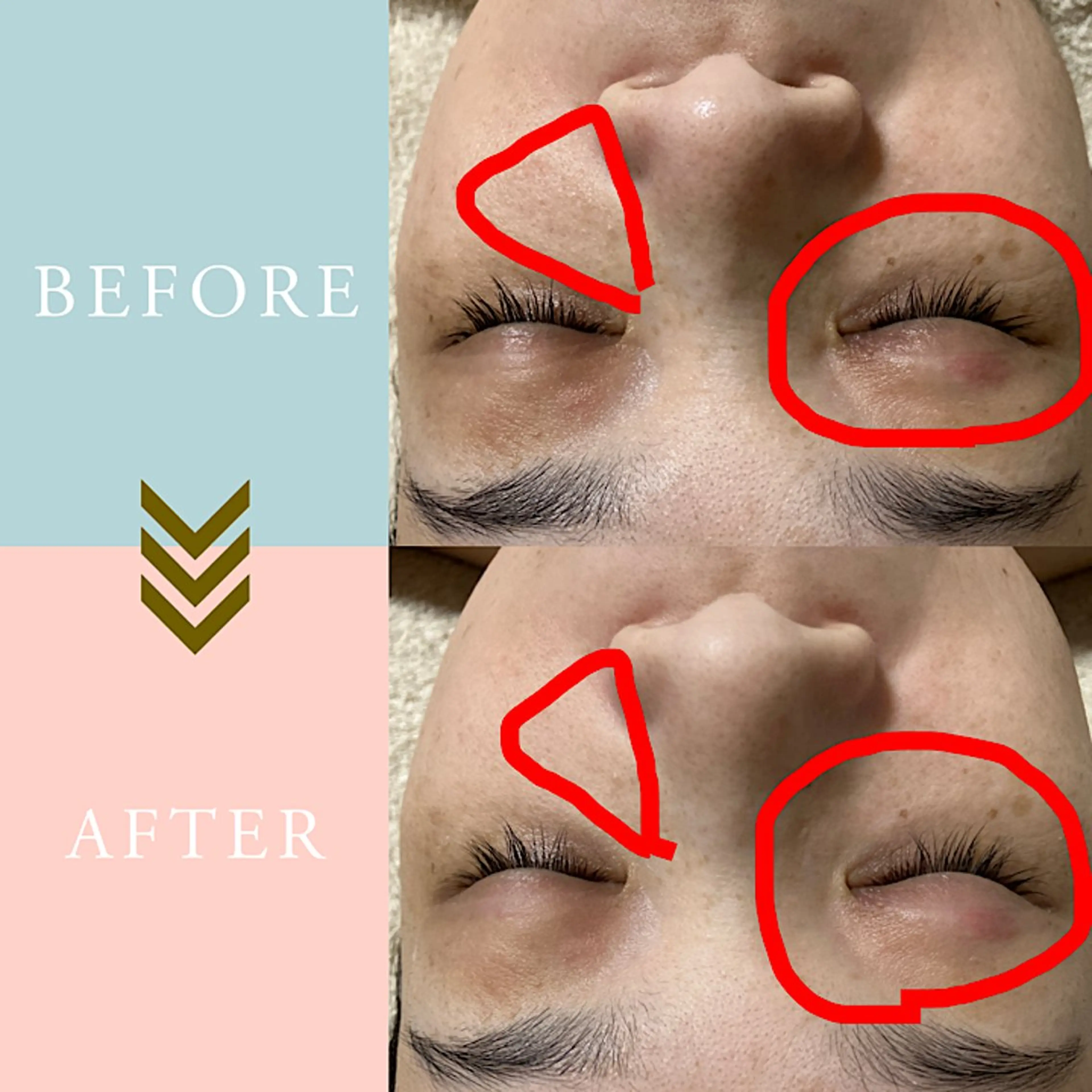 繰り返すニキビ・毛穴 ✨つくば肌質改善専門のエステ・リラクイメージ