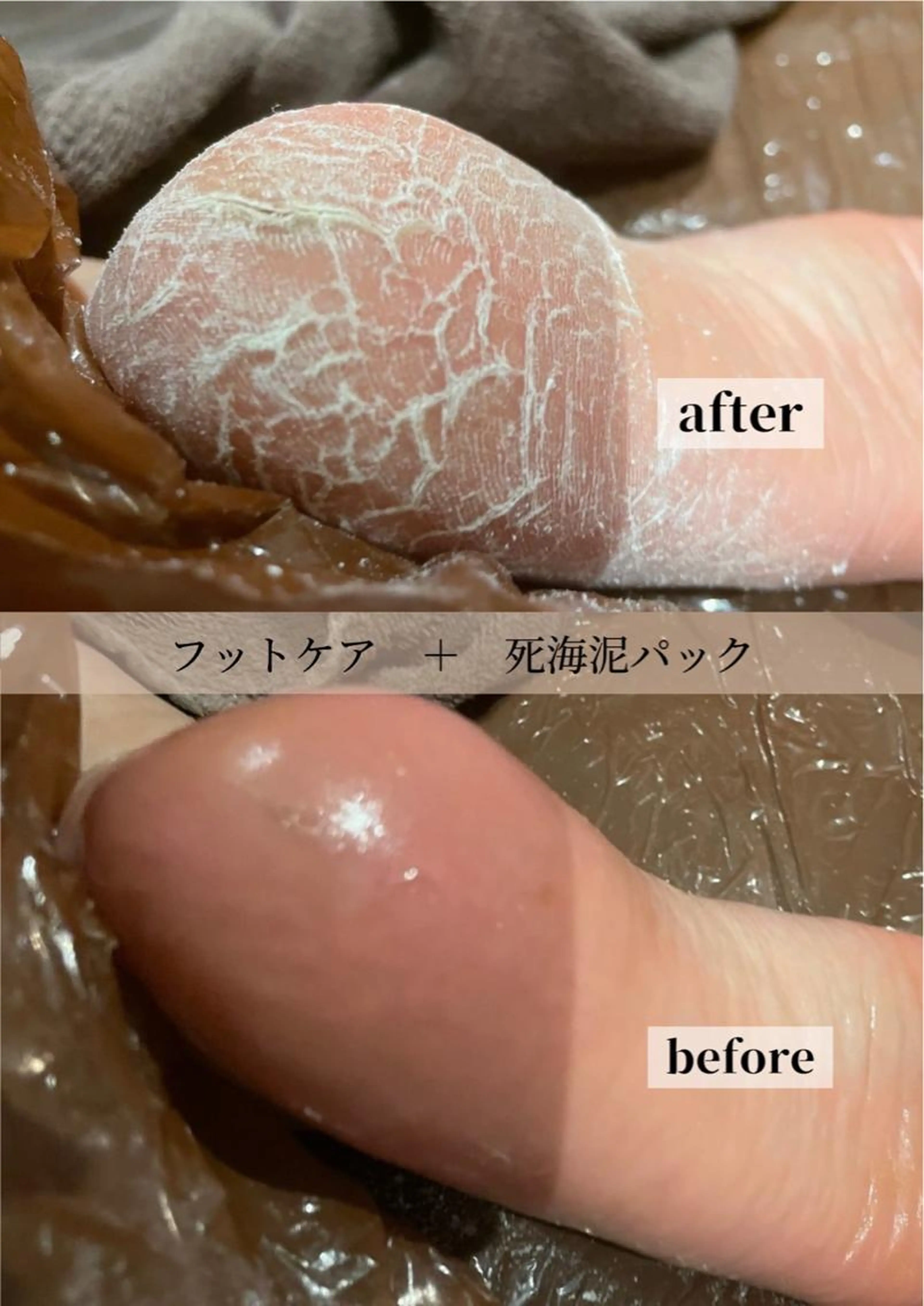 角質ケア&パラフィンパックの写真