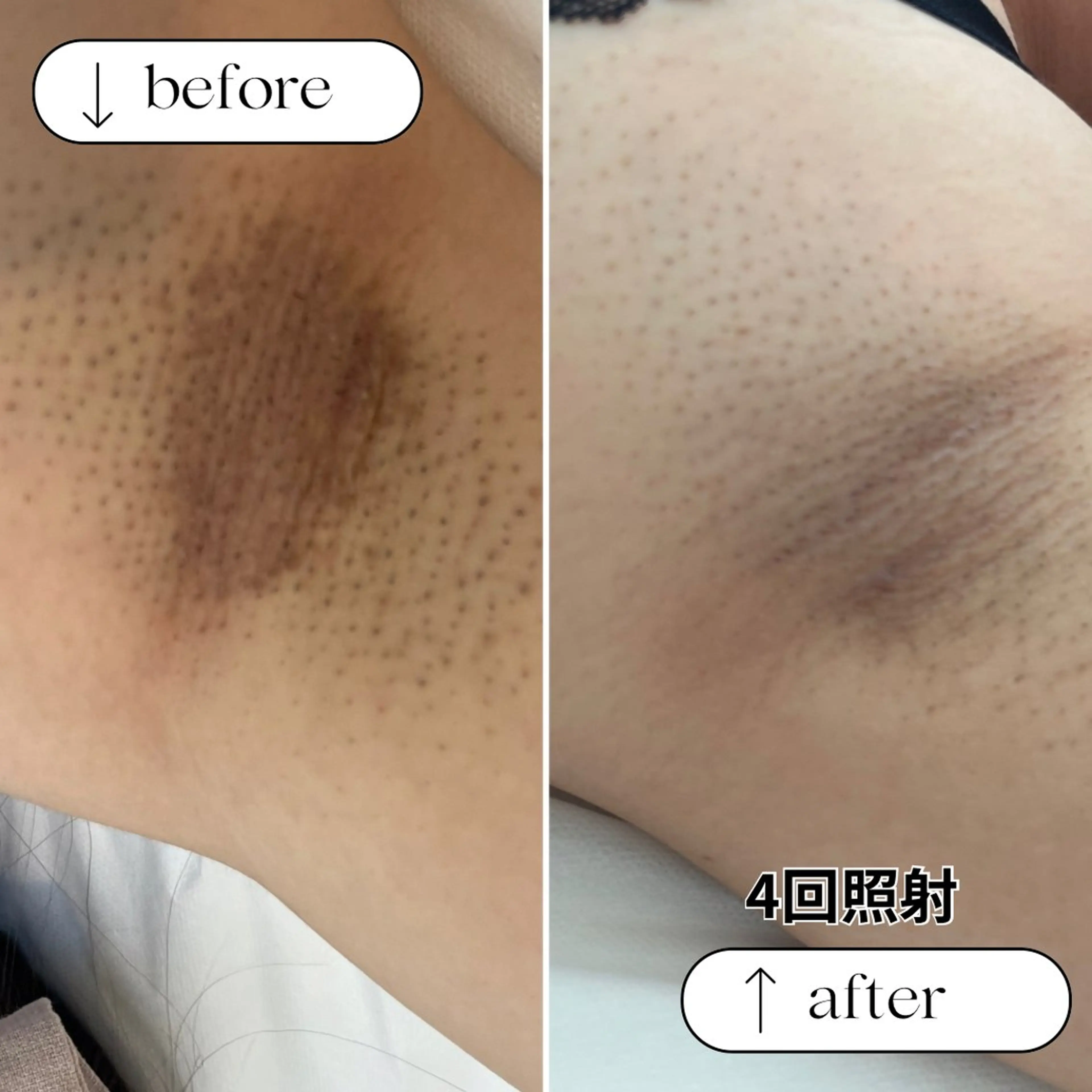 脱毛 ...8room  のエステ・リラクイメージ