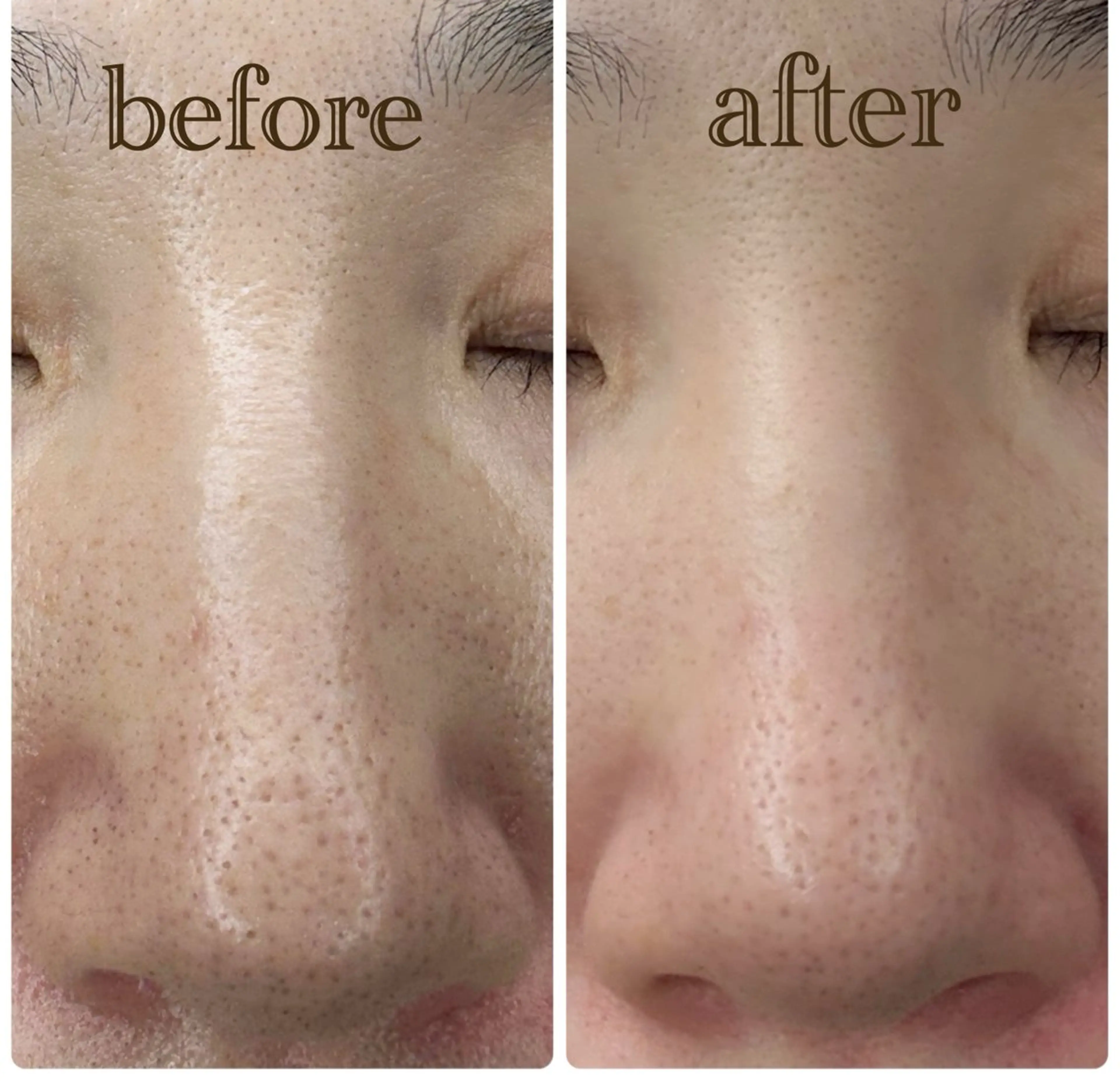 毛穴撲滅メニュー💙肌負担なし!!ピーリング&毛穴洗浄🫧超音波で毛穴の奥の汚れまで掻き出してむき卵肌に🥚の写真