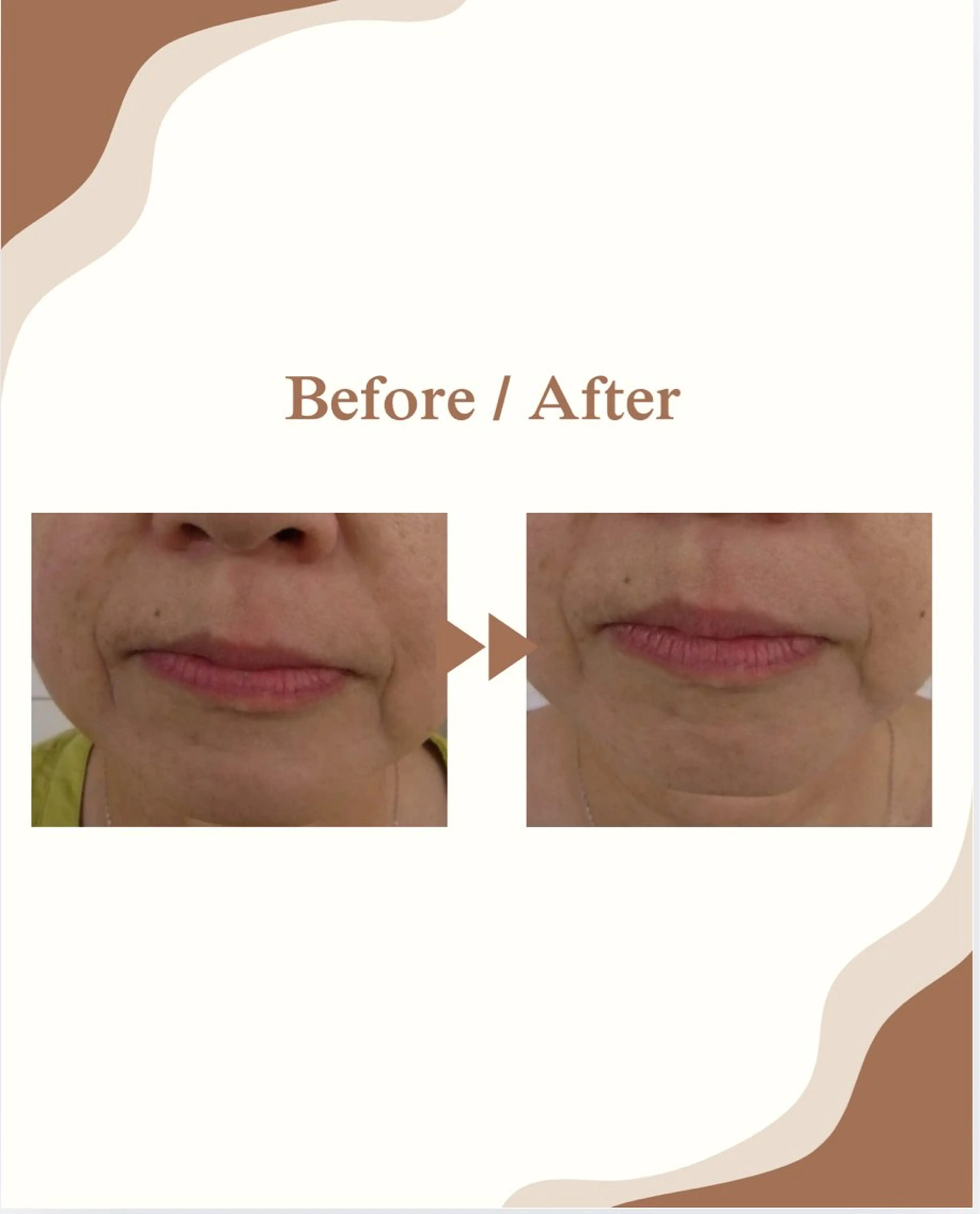 シワ・たるみ改善(90分)の写真