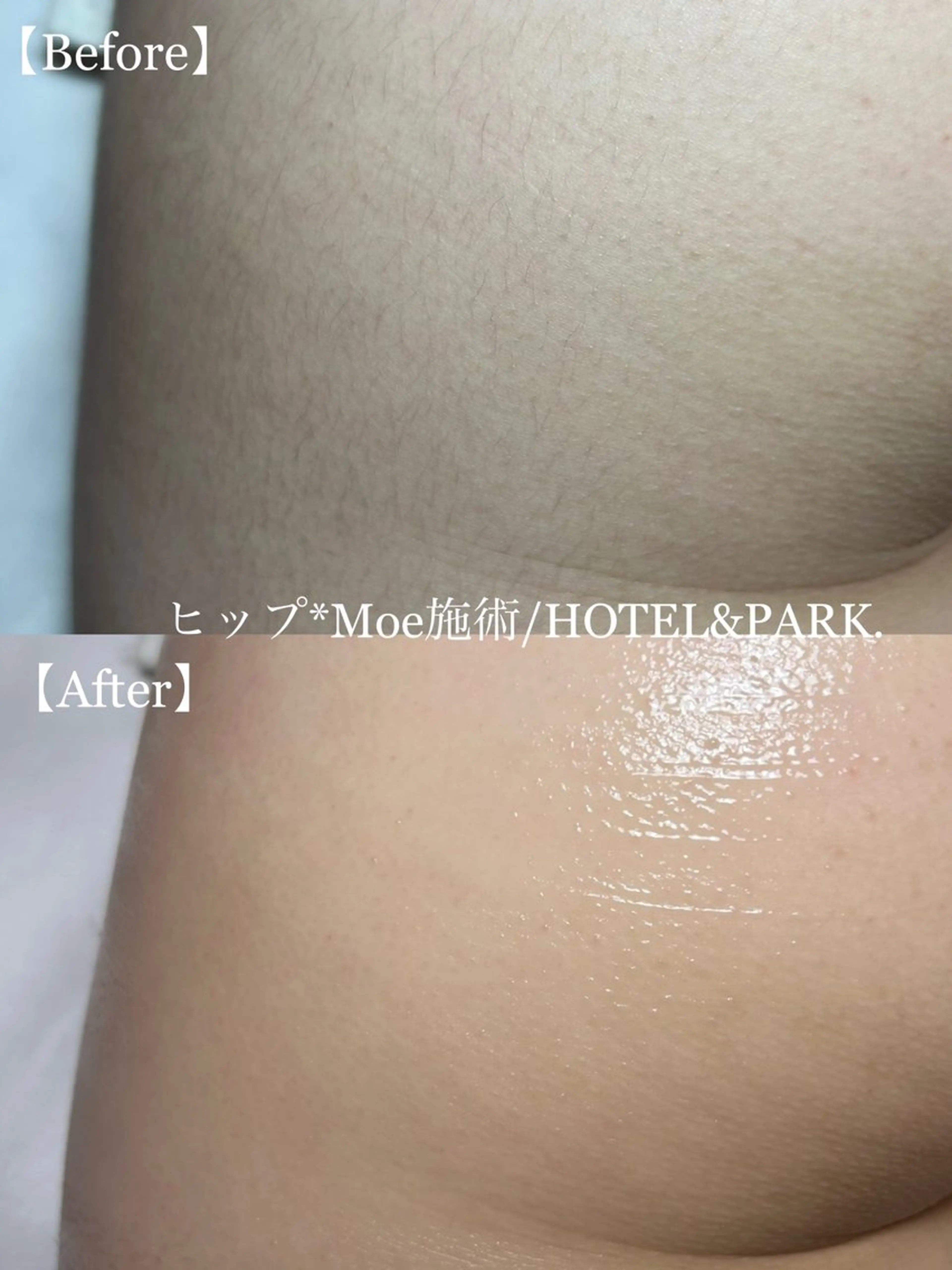 HOTEL&PARK . ワックス脱毛のエステ・リラクイメージ