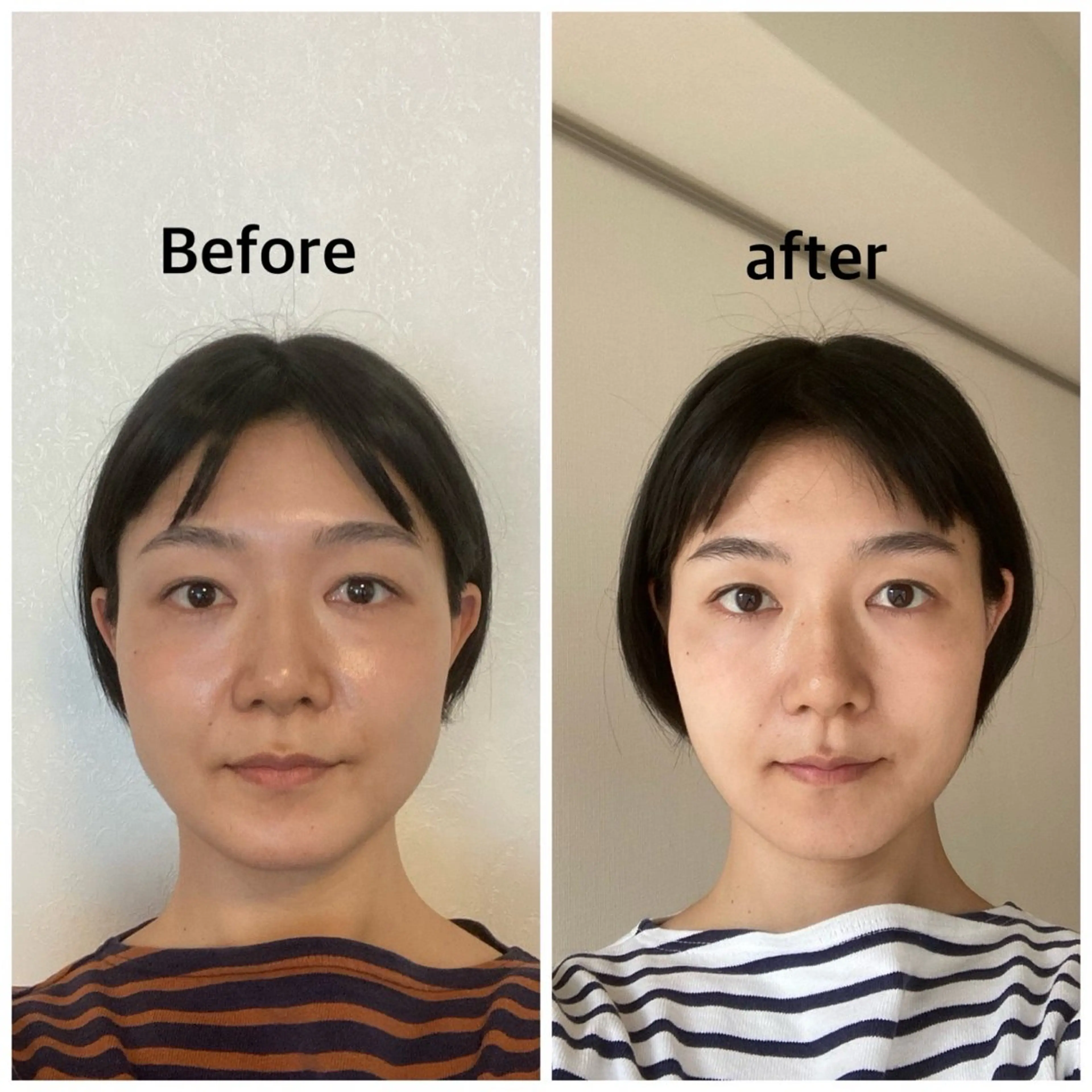 小顔矯正　新技導入　モニター募集の写真