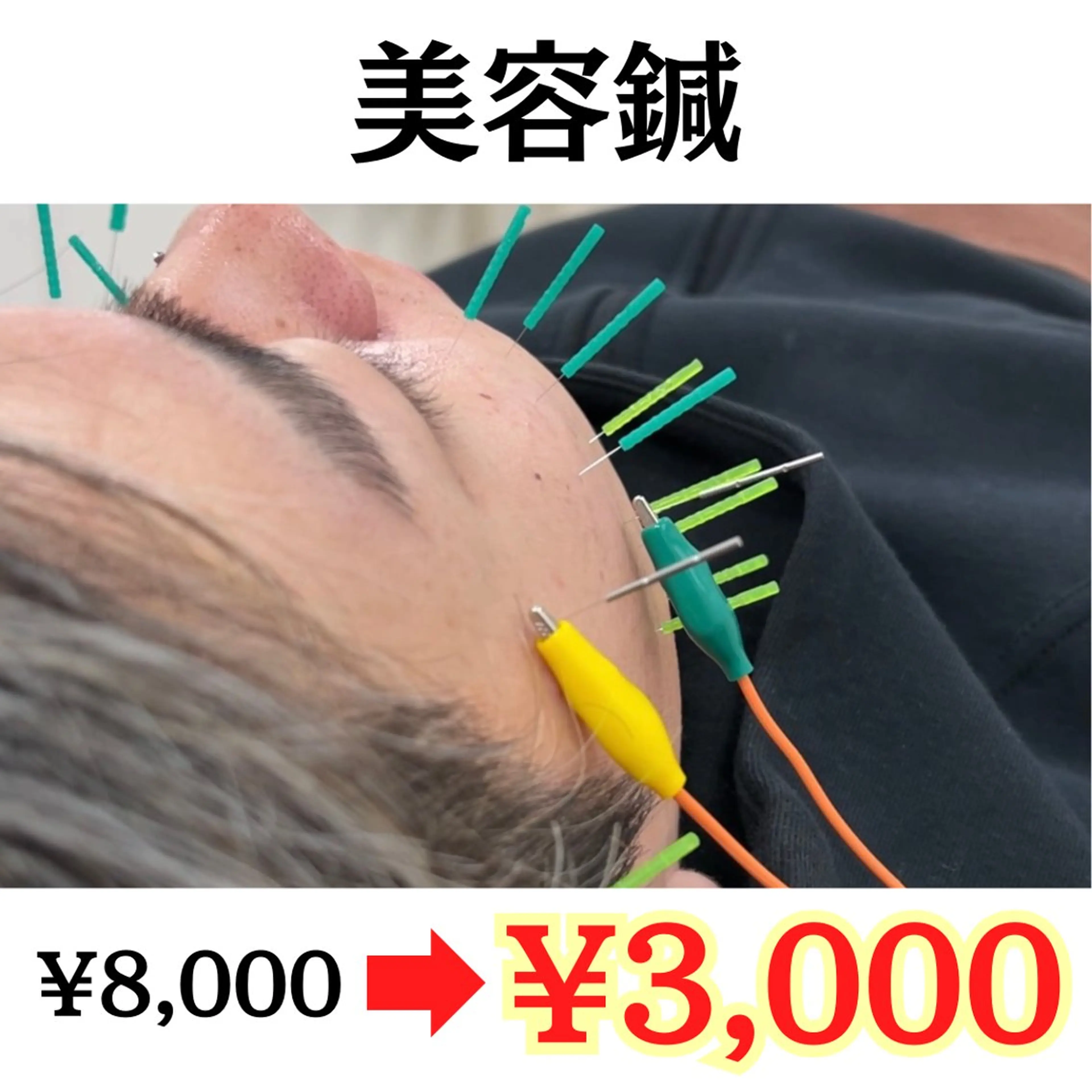 【✨ミニモSALE✨】美容鍼(たるみ 小顔 ほうれい線 目の疲れ)(60分)の写真