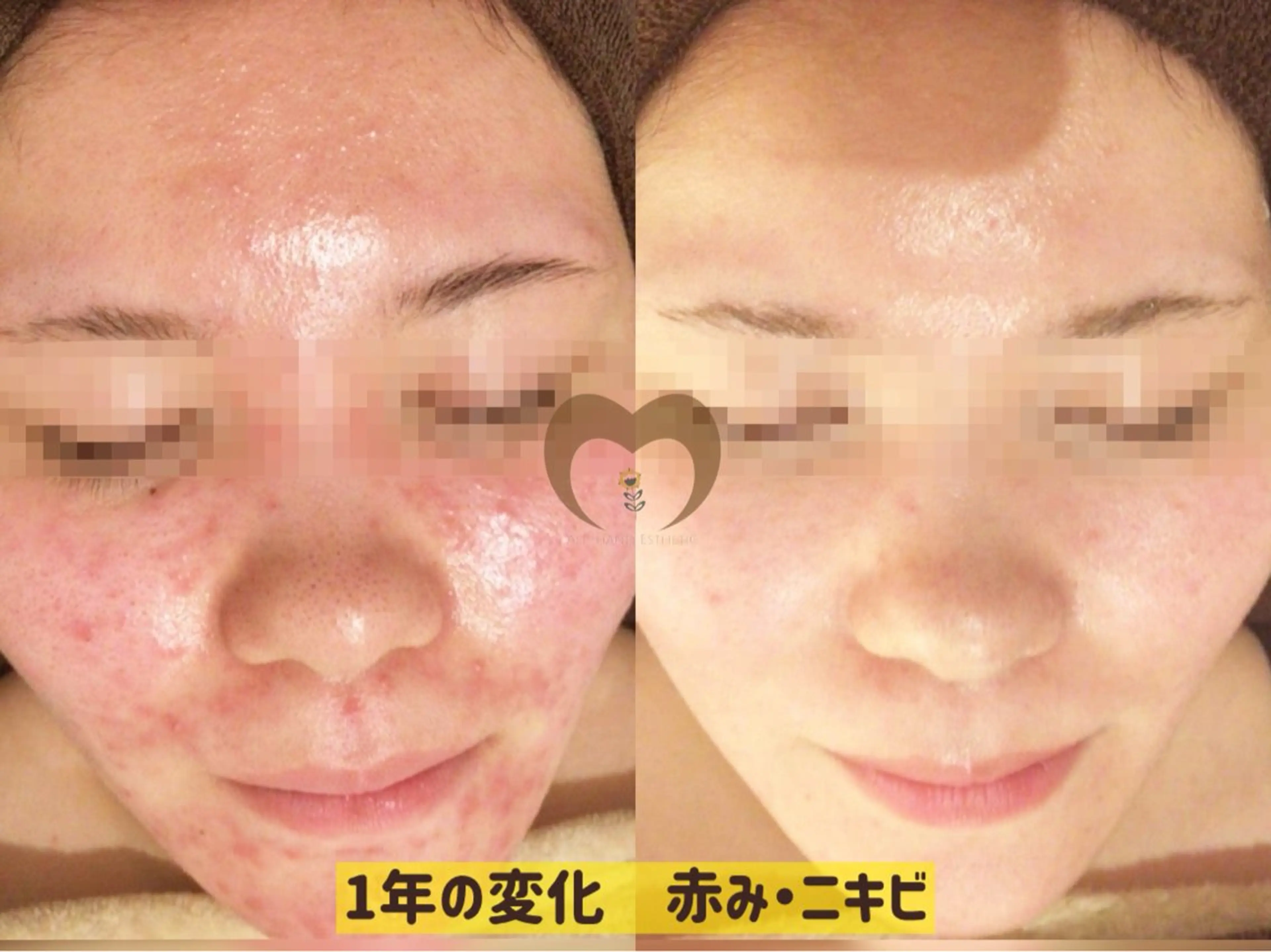 繰り返すニキビ・毛穴 ✨つくば肌質改善専門のエステ・リラクイメージ