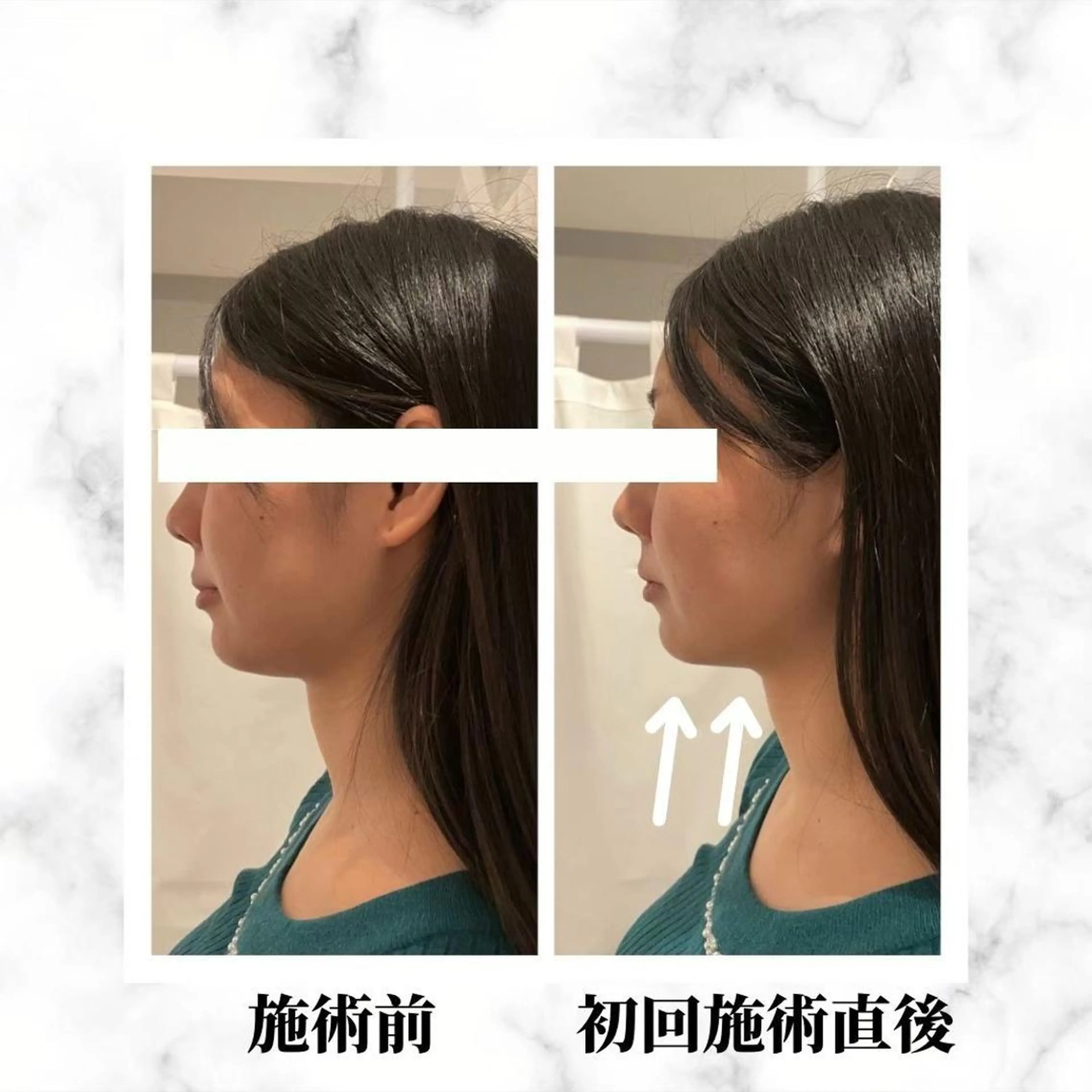 12Dハイフ💗 最強小顔のエステ・リラクイメージ