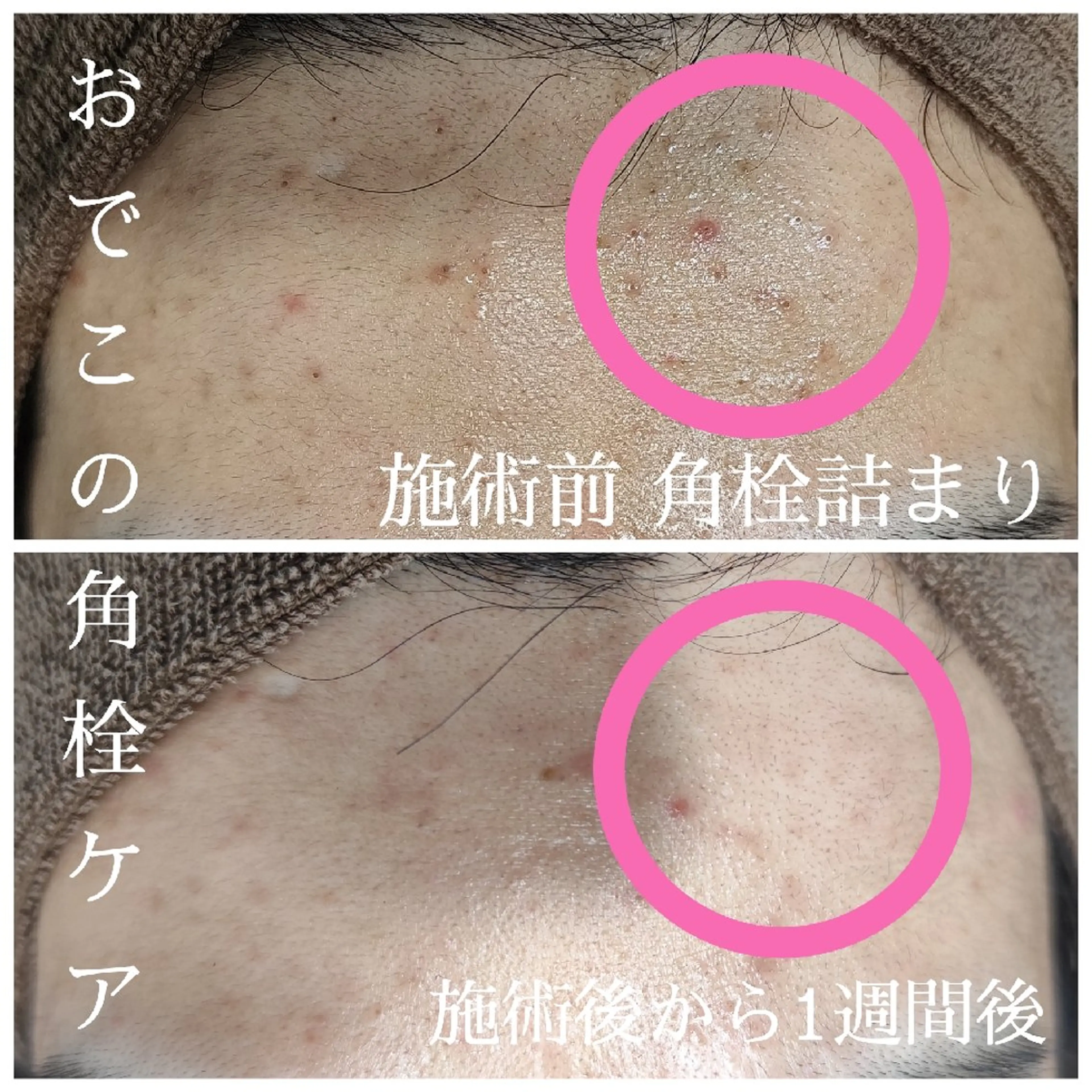 シミそばかす/ニキビ/ニキビ跡に！光フォトの写真