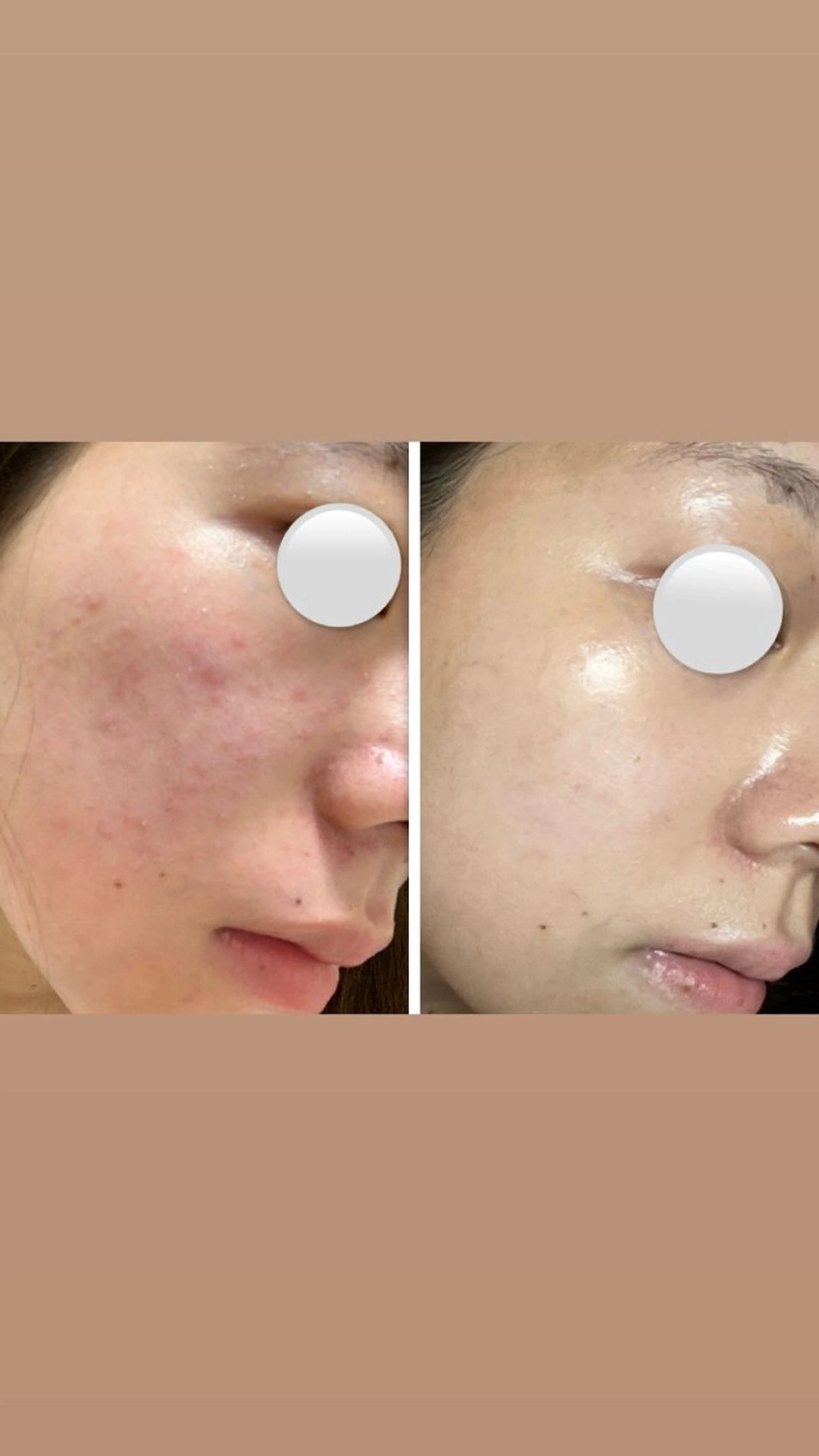 肌の質を変えるエステ 🤍🫧Nanaのエステ・リラクイメージ