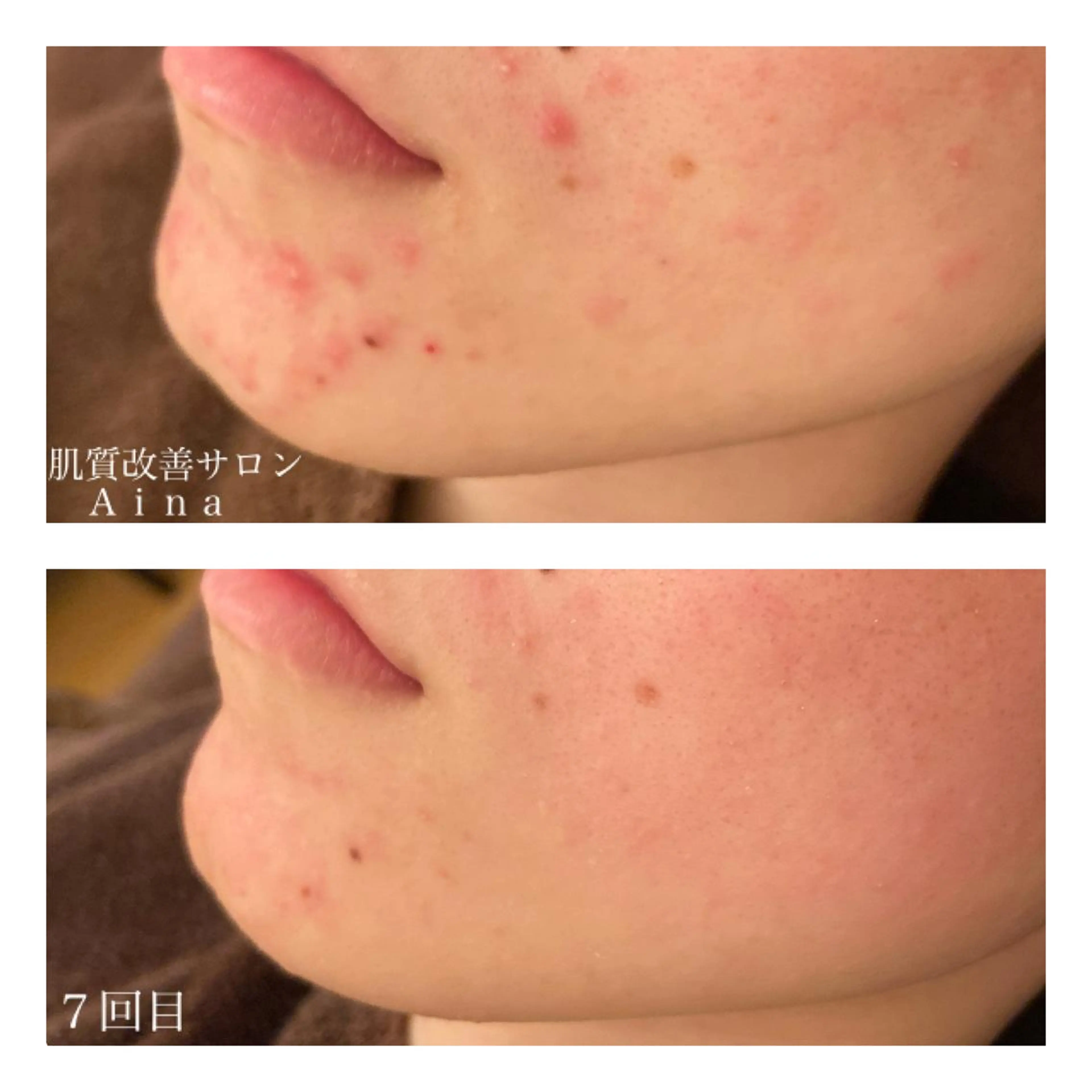 ミディアム カラー パーマ ヘアアレンジ メンズ キッズ ネイル マツエク・マツパ 赤色 エステ リラク ニキビ跡専門サロン Ainaのエステ・リラクイメージ