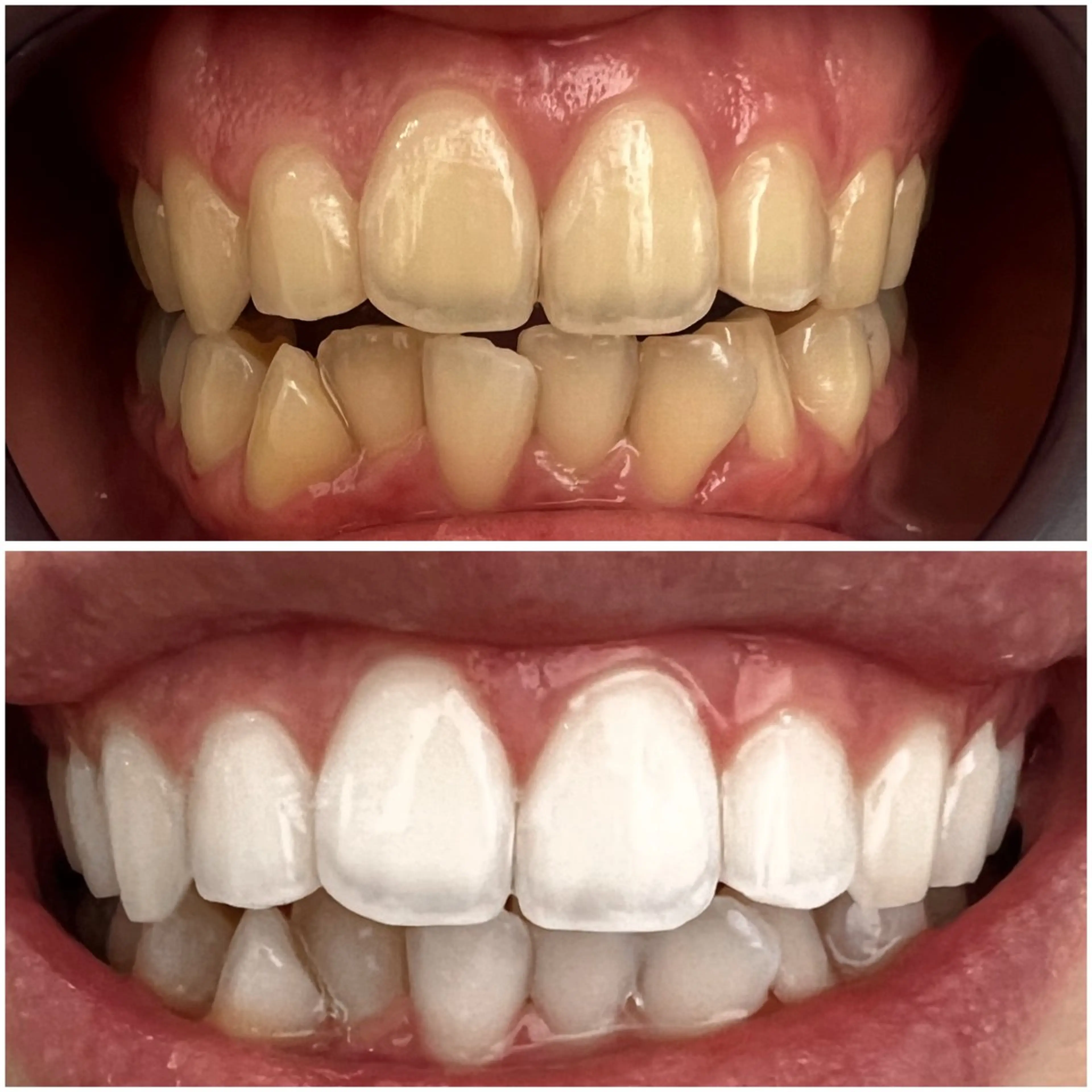 直前割🈹高濃度ジェルホワイトニング30分連続照射😉の写真