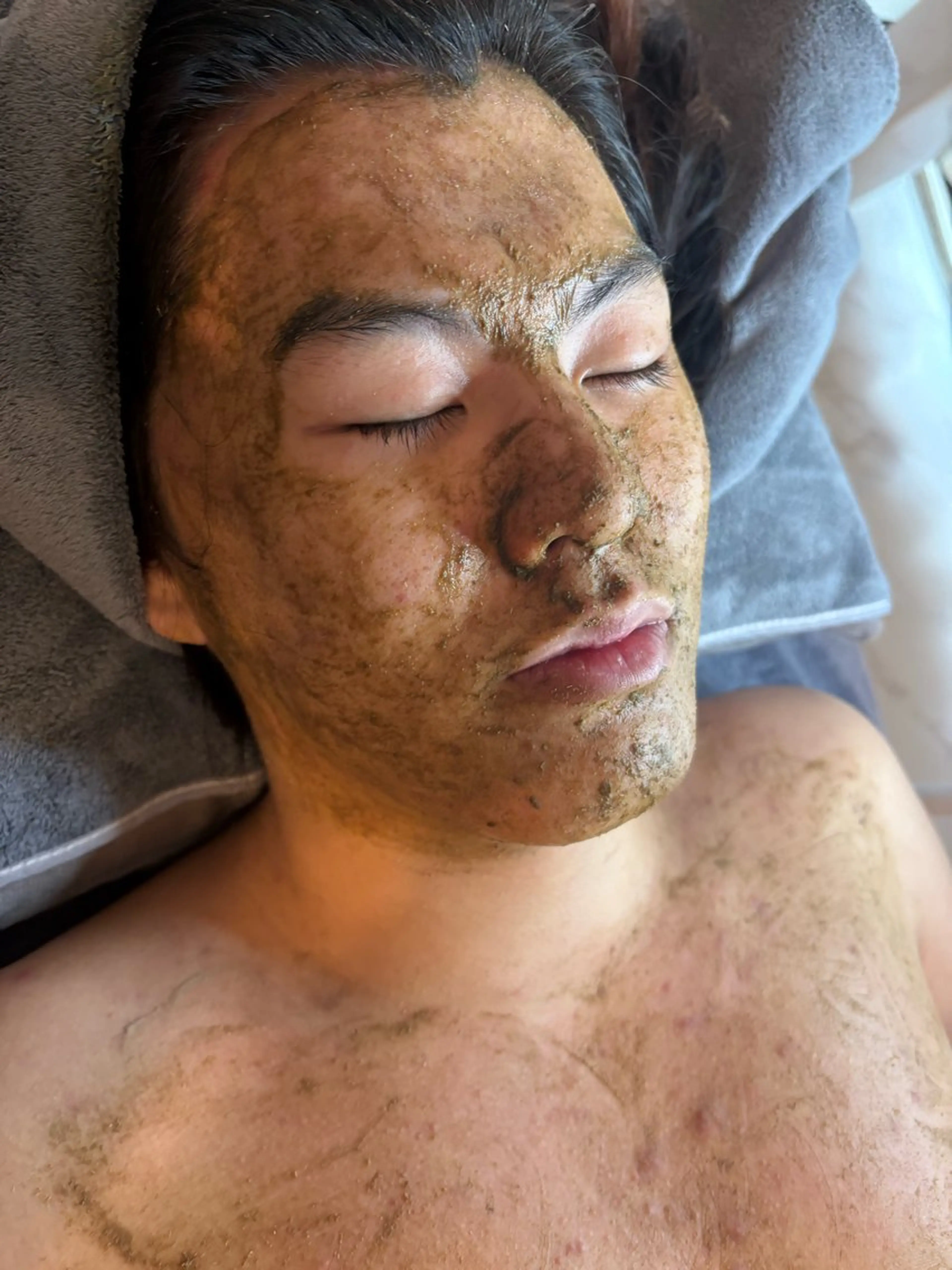 ハーブピーリング🌿剥離あり　お顔＋デコルテまでの写真