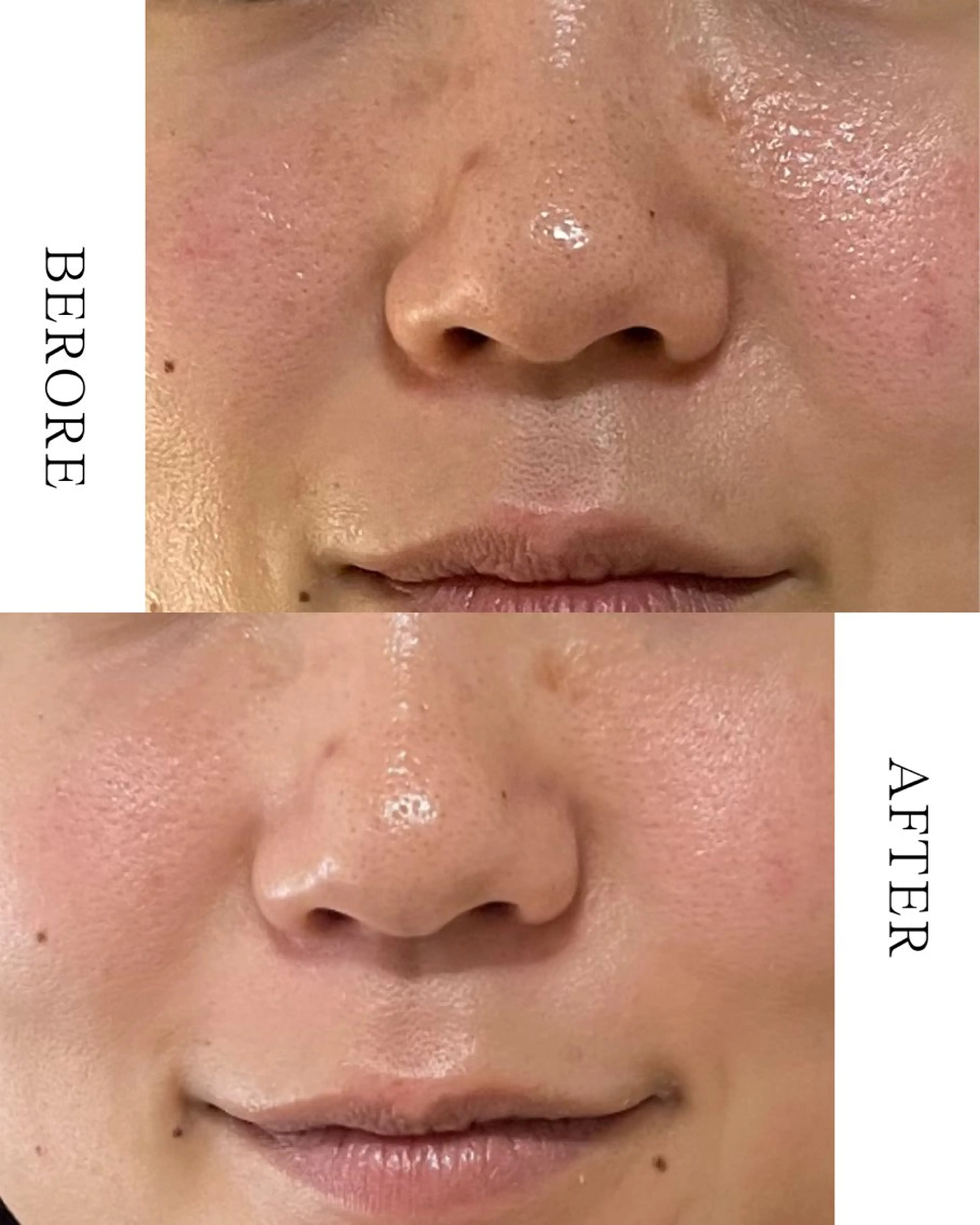 ✨韓国クリニック発🇰🇷話題のララピール✨の写真