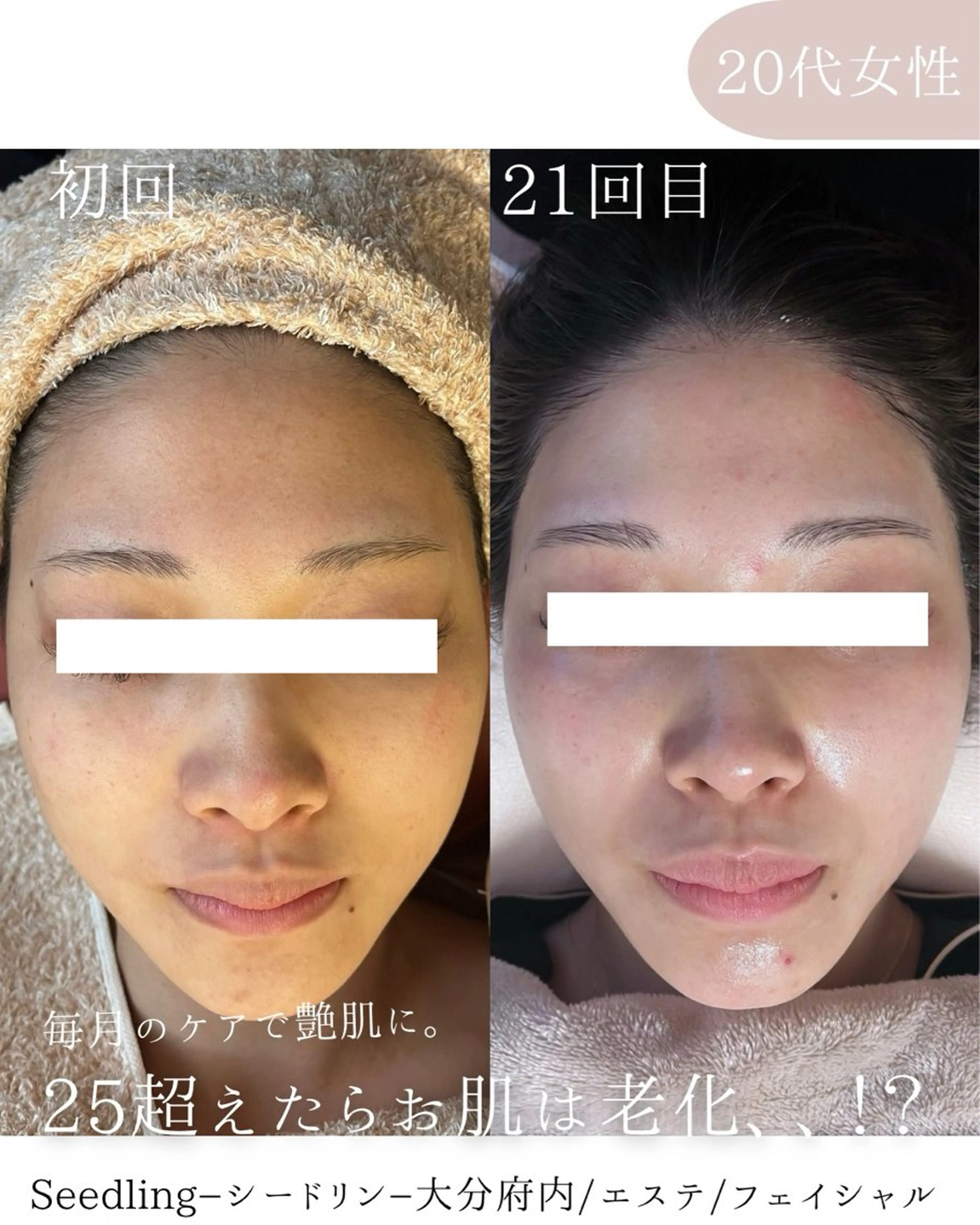 脱毛 シードリン 府内店 小波のヘアスタイル