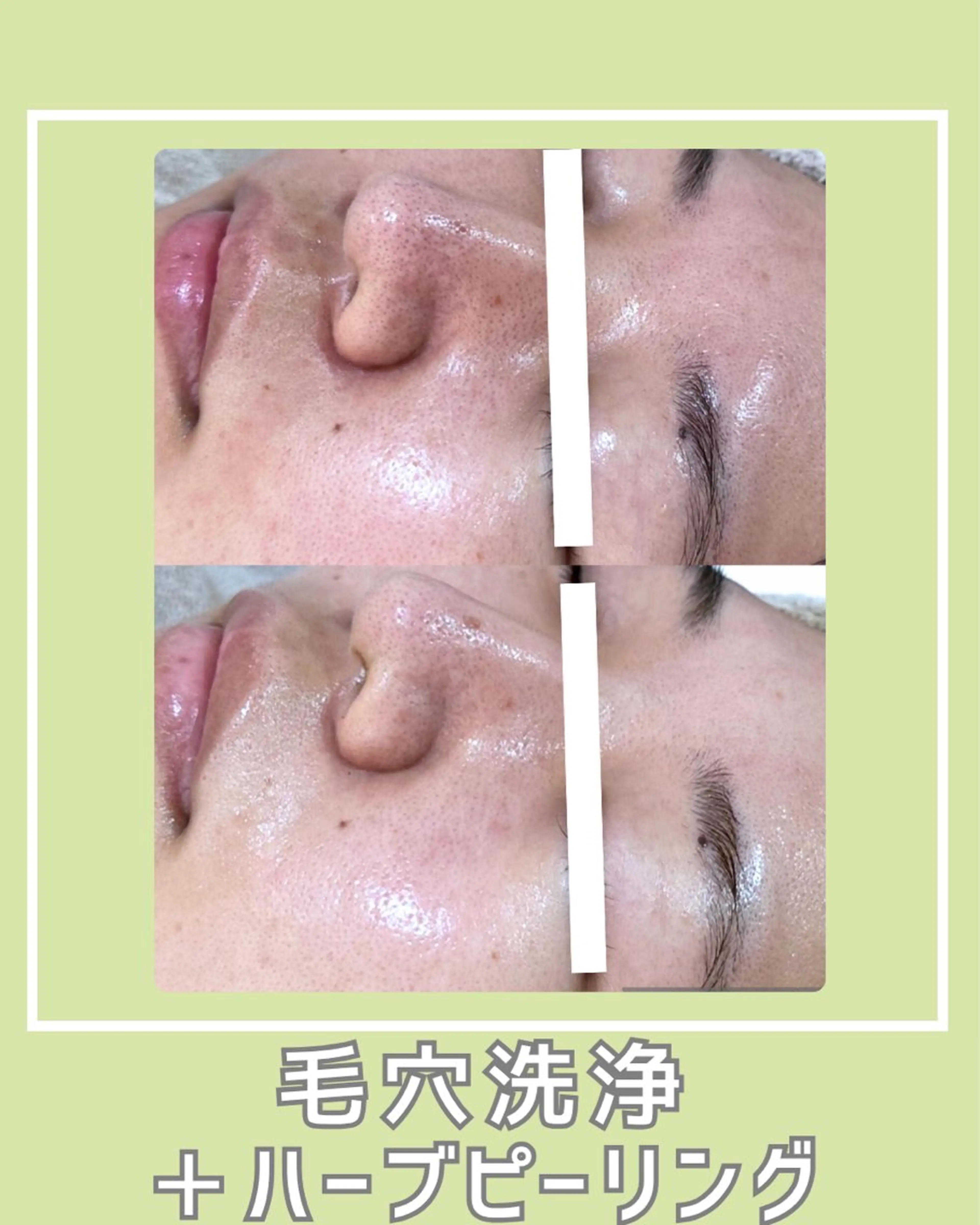 |ピーリング・毛穴| soina神楽坂のエステ・リラクイメージ