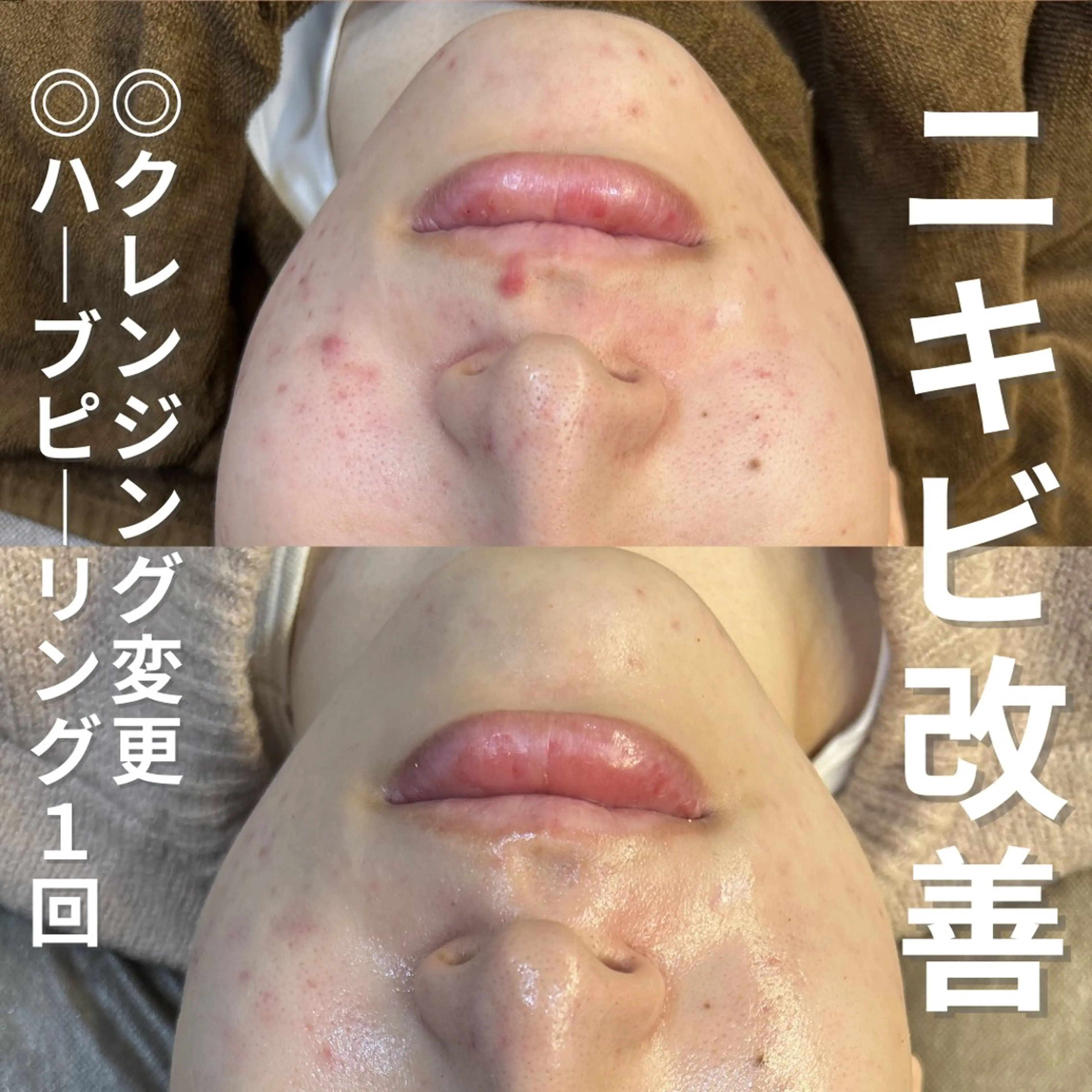 エステ ニキビ・ニキビ跡改善 leoloのエステ・リラクイメージ