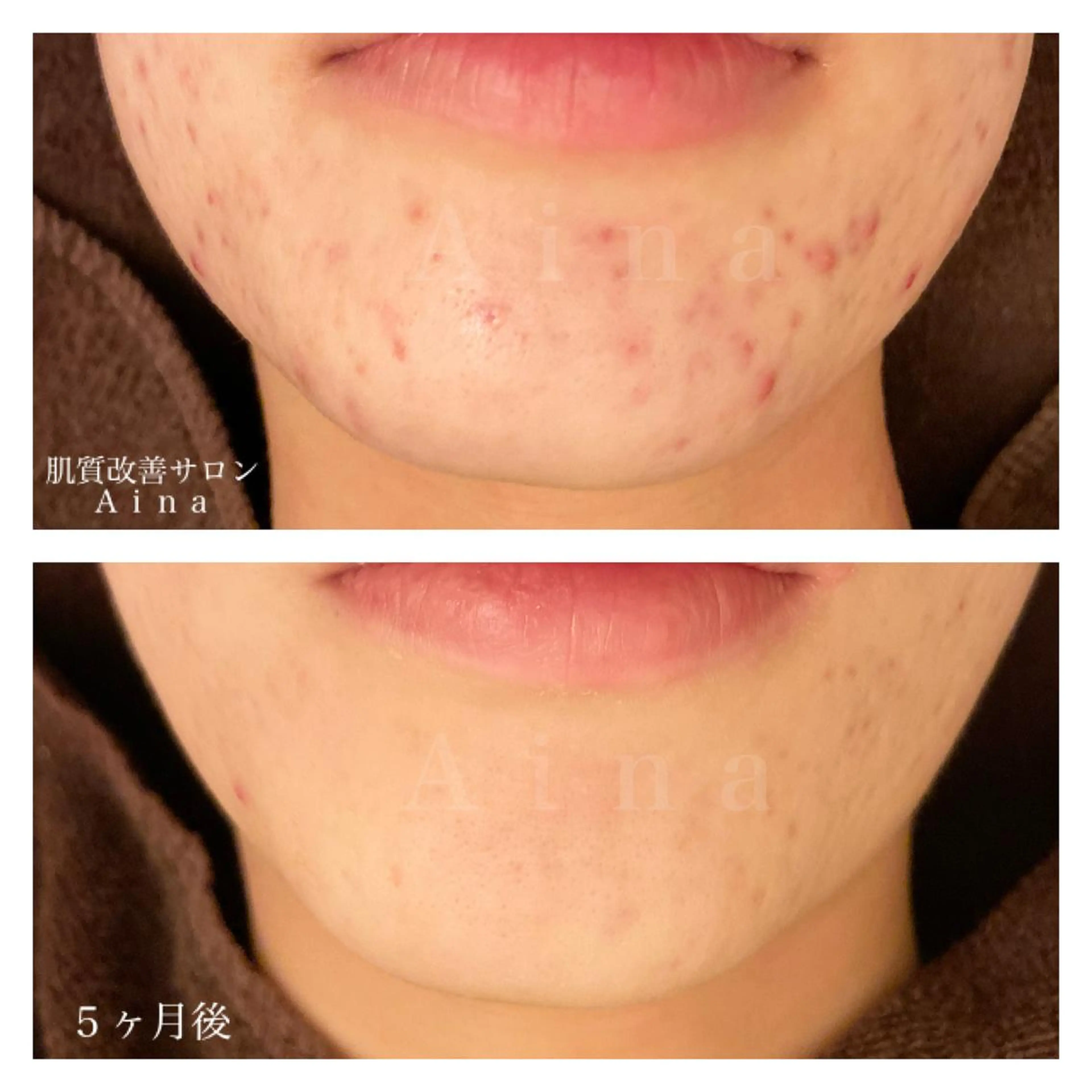 ミディアム カラー パーマ ヘアアレンジ メンズ キッズ ネイル マツエク・マツパ 赤色 エステ リラク ニキビ跡専門サロン Ａｉｎａのエステ・リラクイメージ