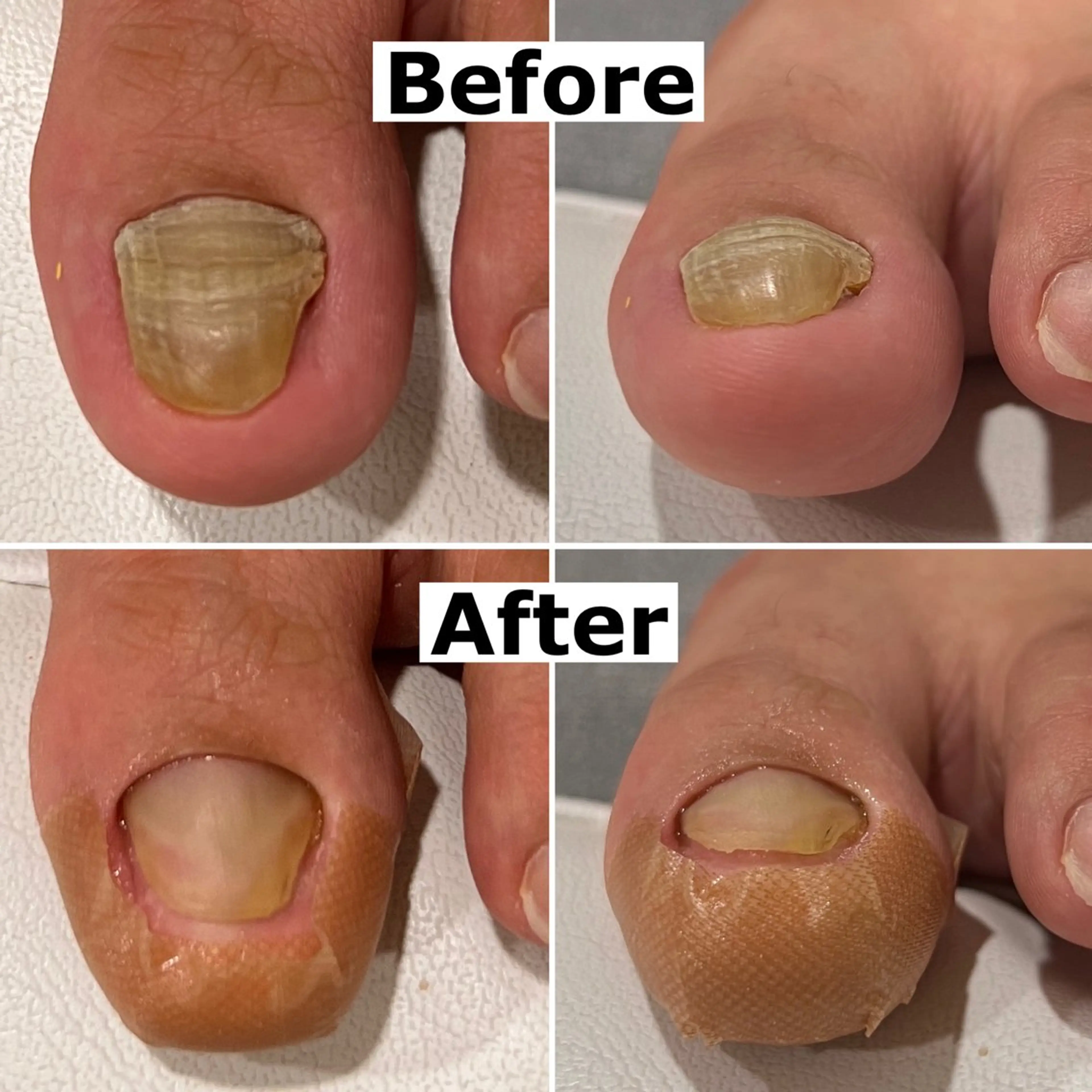 巻爪無料モデル募集 ✨🦶MEGUMIのネイルデザイン