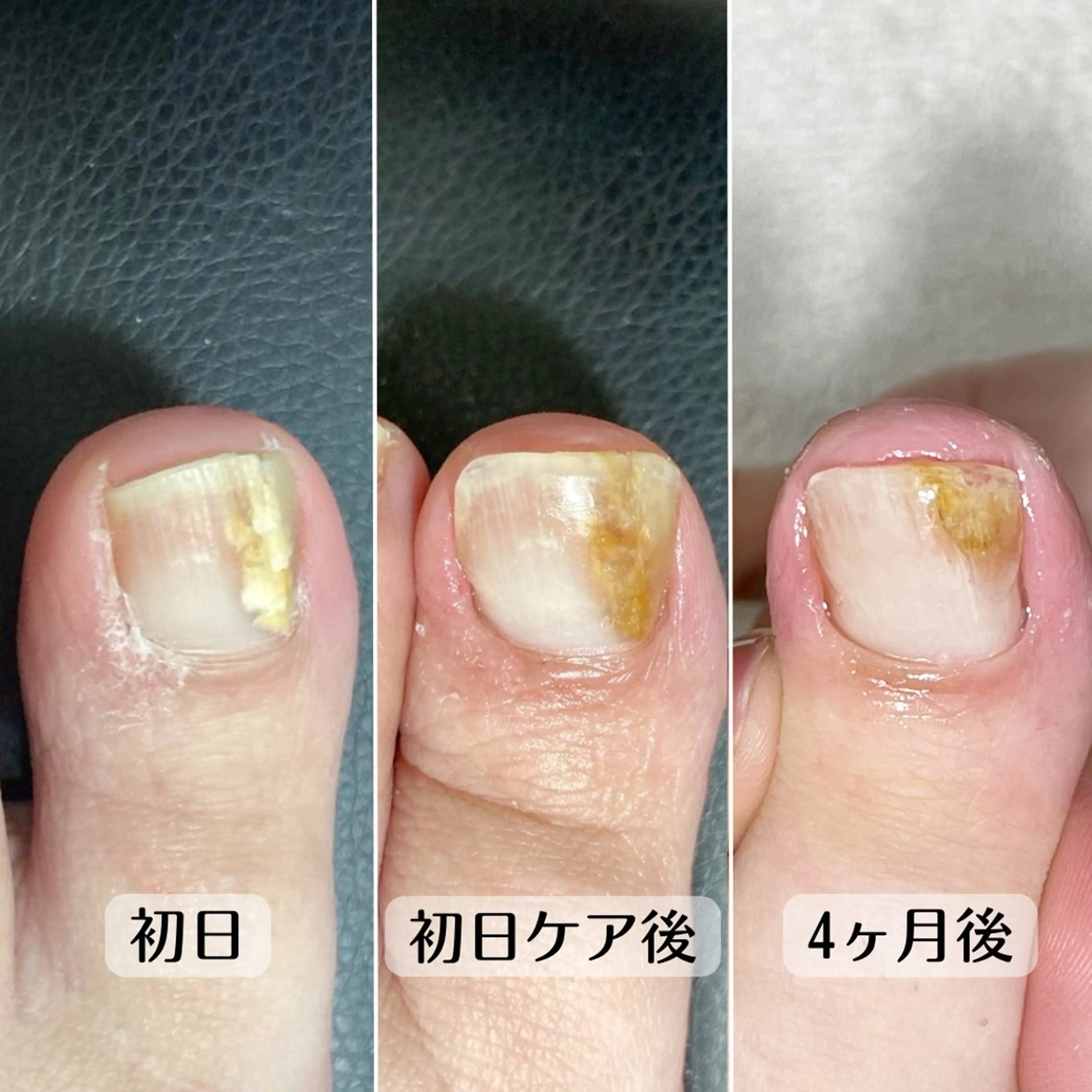 ネイル 深爪・巻き爪 専門サンセリテのネイルデザイン