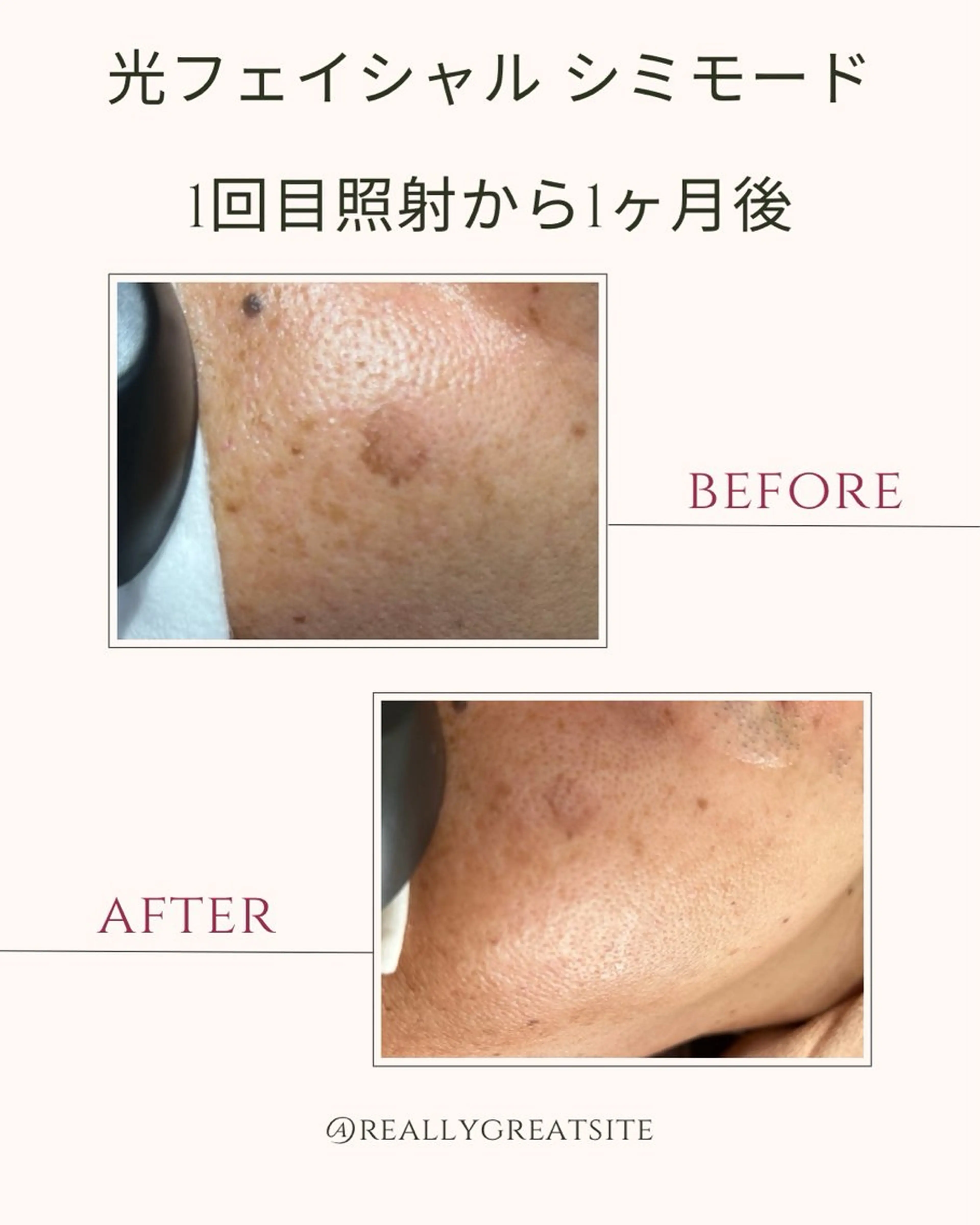 メンズ Felice🌸脱毛 ・光フェイシャルのエステ・リラクイメージ