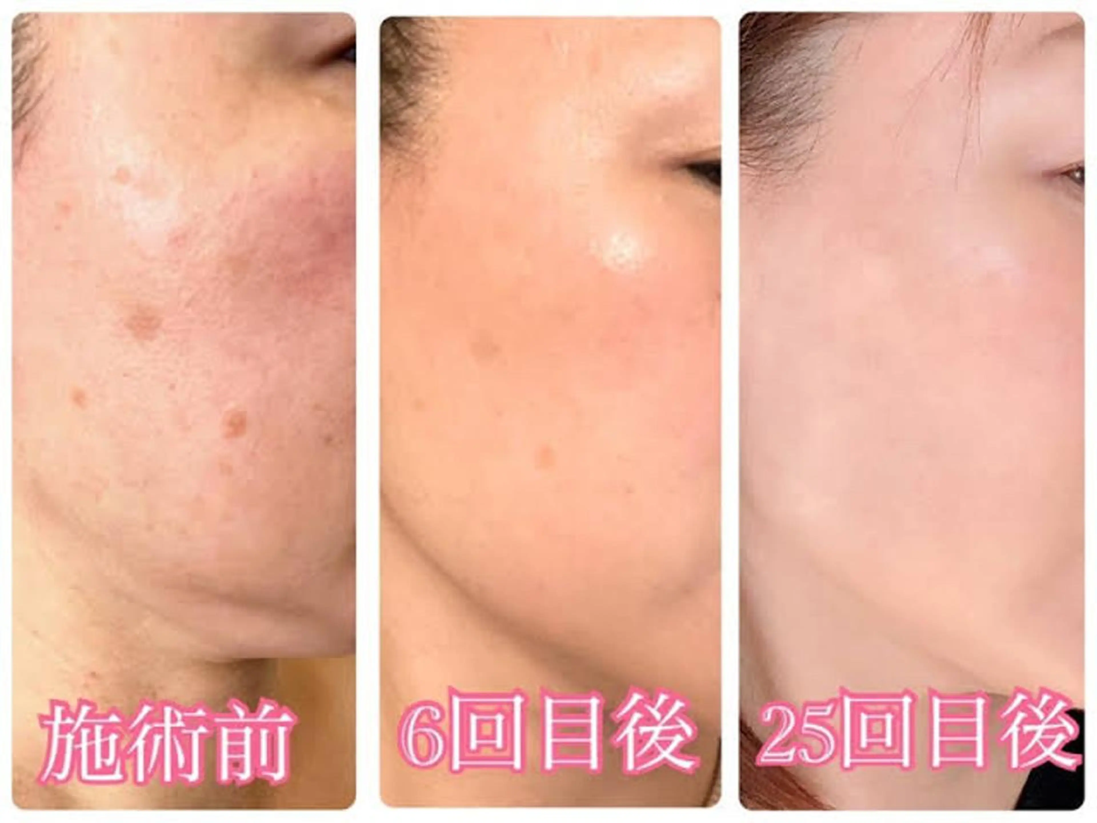 肌質改善VOSイノスピキュール15万本の写真