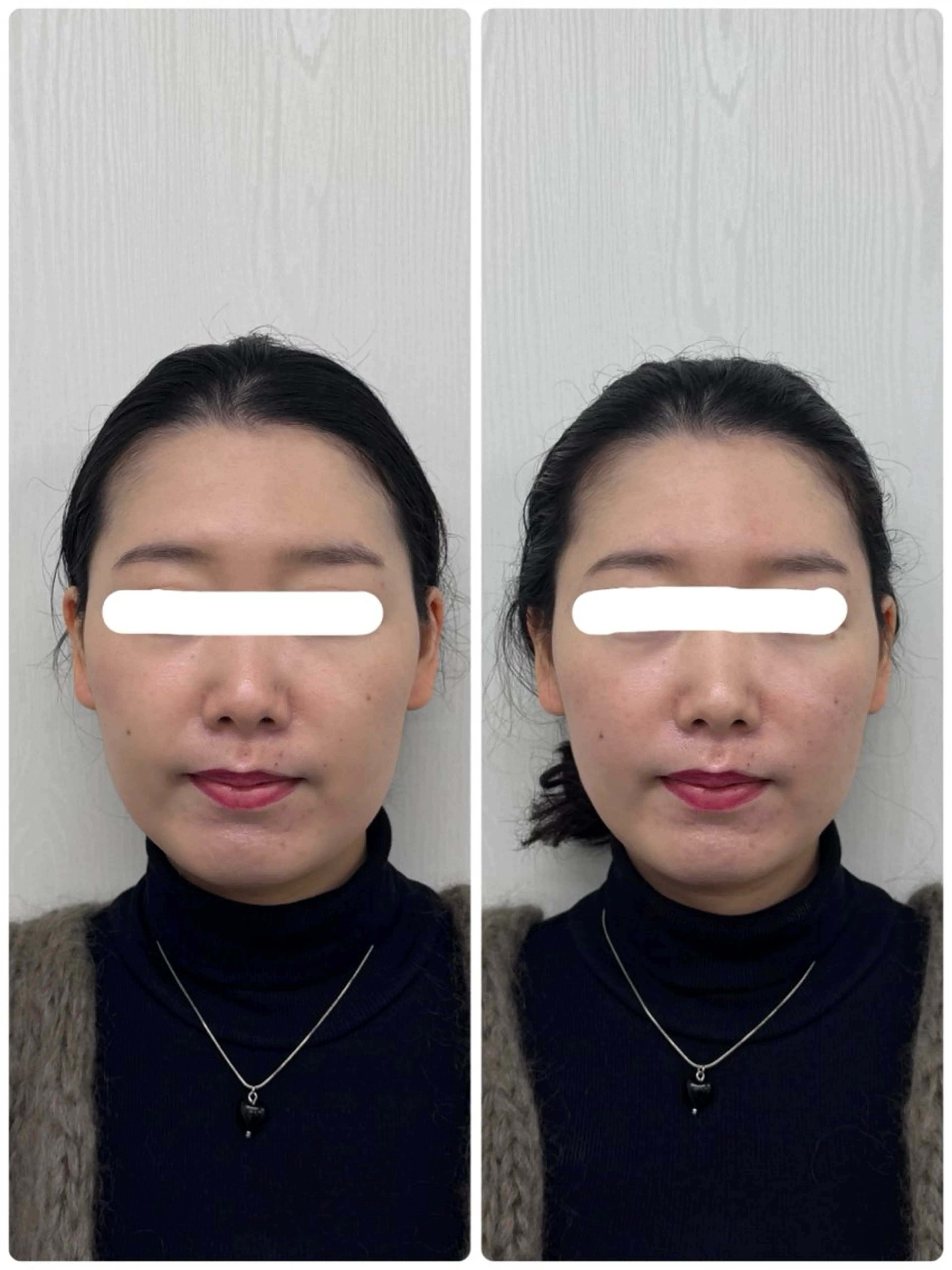 エステ リラク 美容鍼×小顔矯正 ×美容整体　浜川泰仁のエステ・リラクイメージ