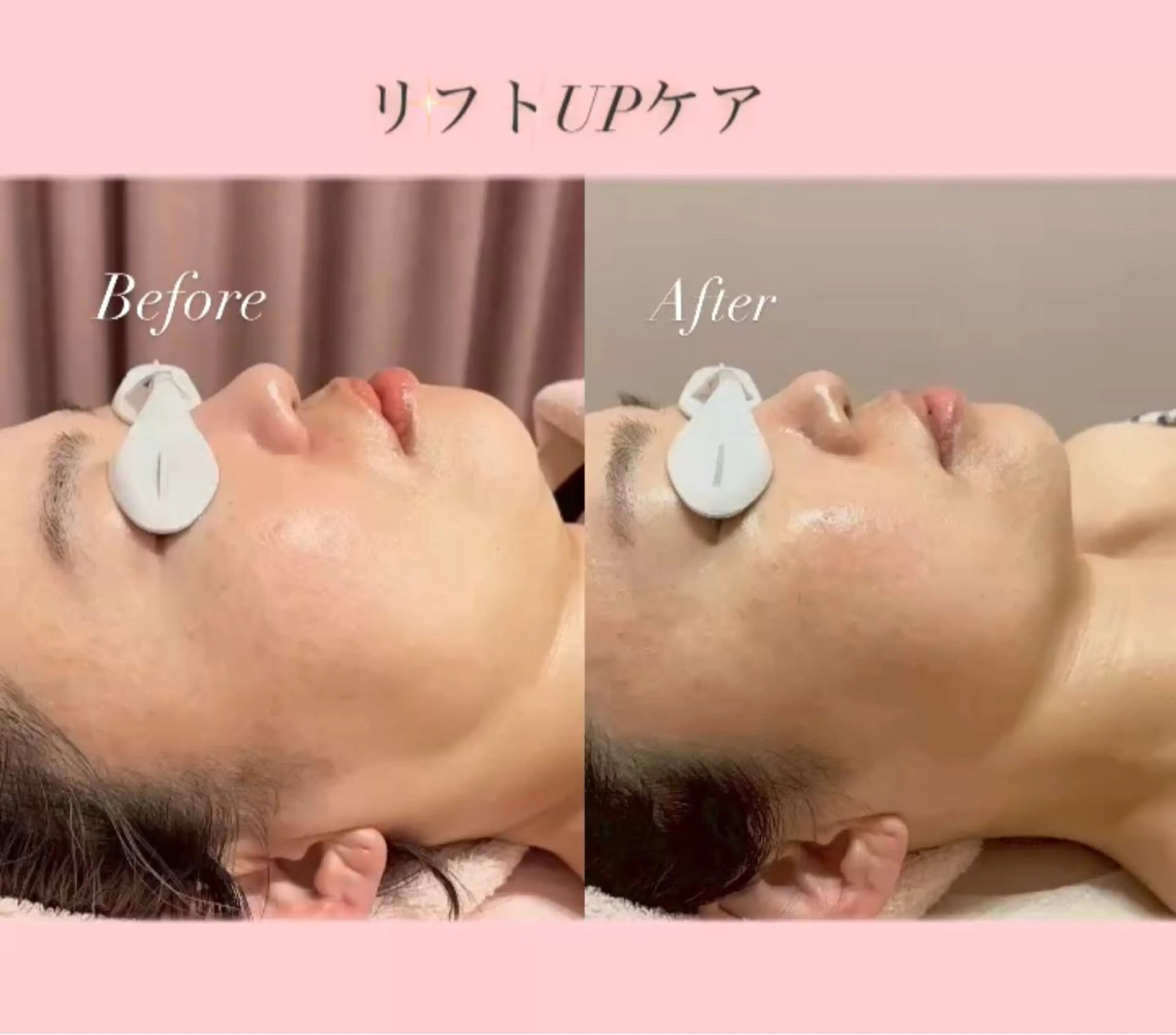 ✨🫧【4月限定】【韓国小顔/すっきりフェイス】リフトUP小顔フェイシャル💆🫧✨の写真