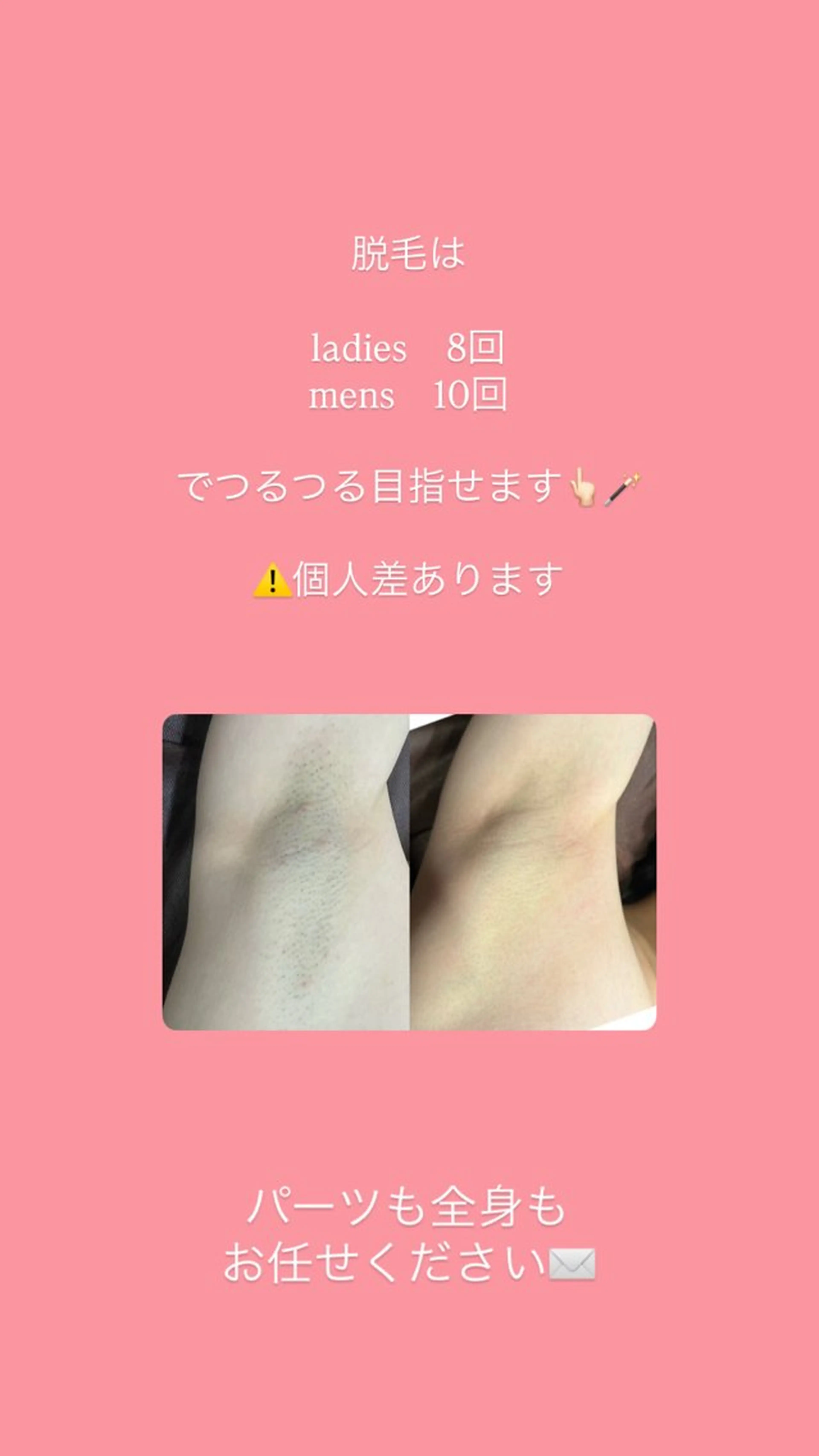 全身脱毛（お顔vio込み）お肌優しい美容脱毛の機械で圧倒的な効果を是非お試しください❤️‍🔥の写真