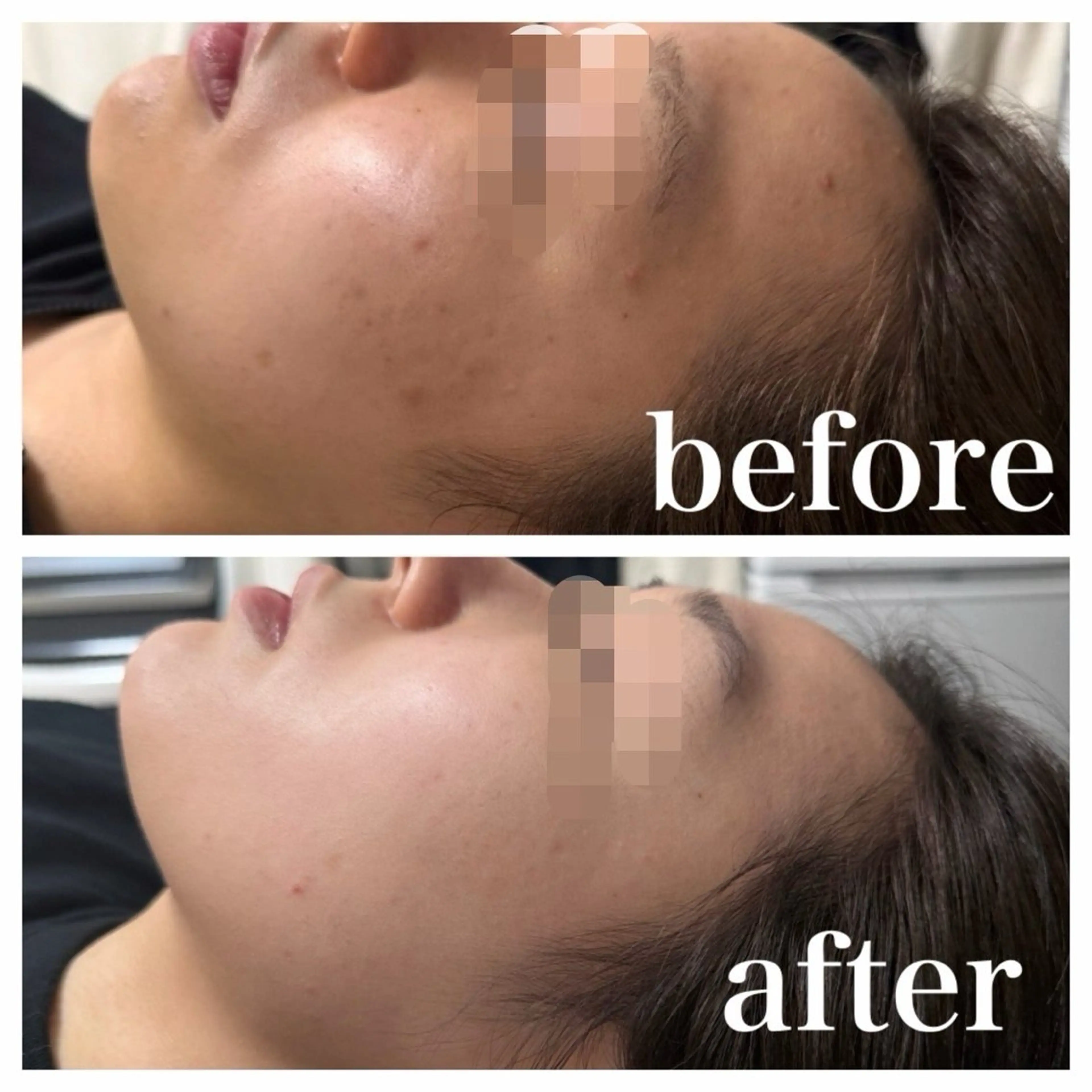 OLYMPIA 小顔 ハーブピーリングのエステ・リラクイメージ