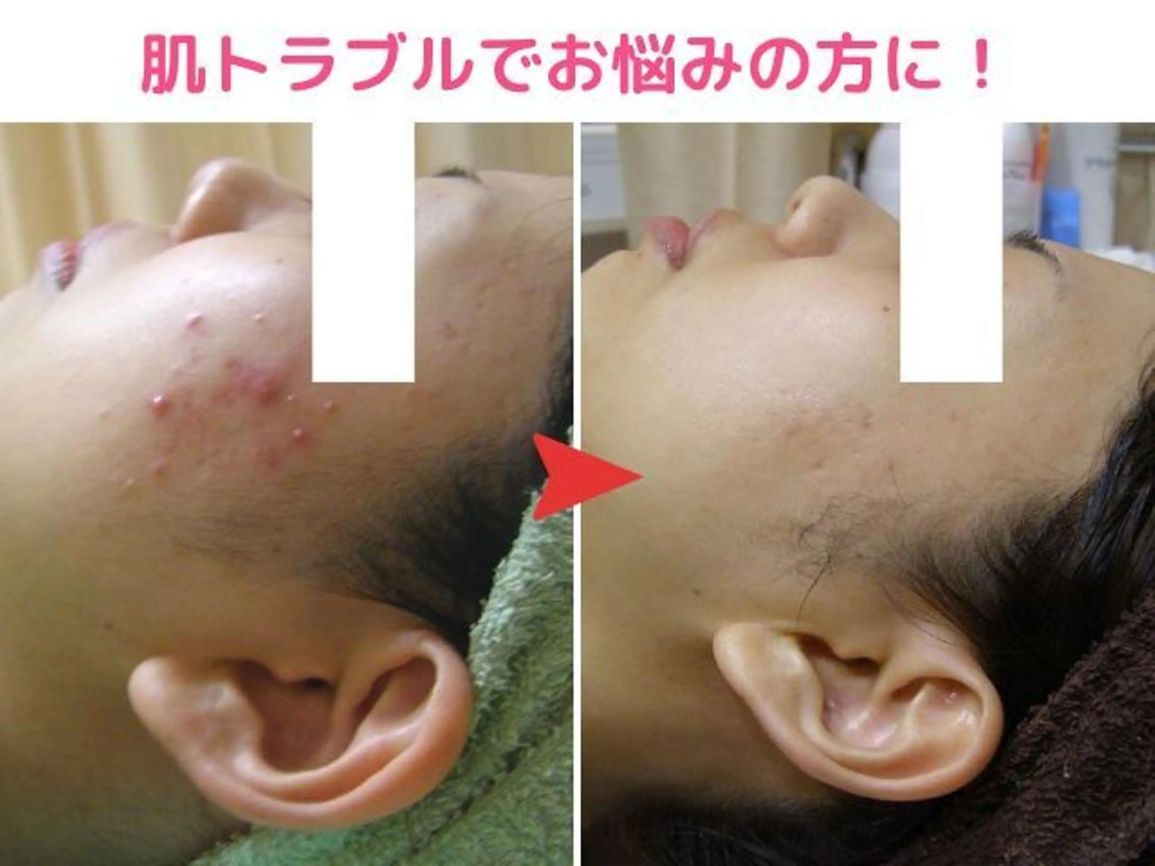 無剥離♪ハーブピーリングを超えた次世代艶肌シルクピーリング9900円☆ニキビやニキビ跡にもオススメ!の写真