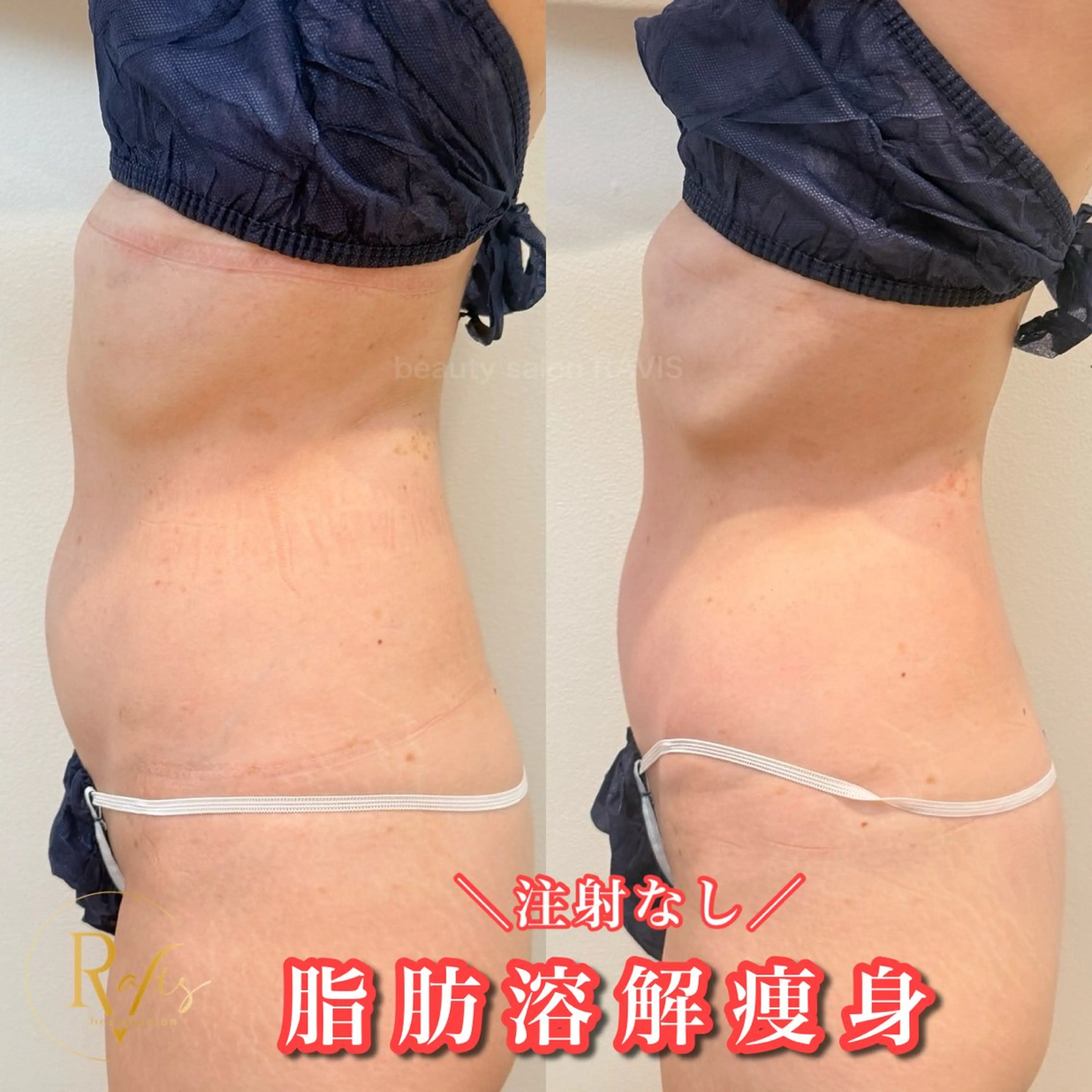 【お腹集中🔥がっつり痩身】針を使わない脂肪撃退剤導入‼️最新マシン×強力デトックスマッサージ/ぽっこりお腹/便秘解消の写真