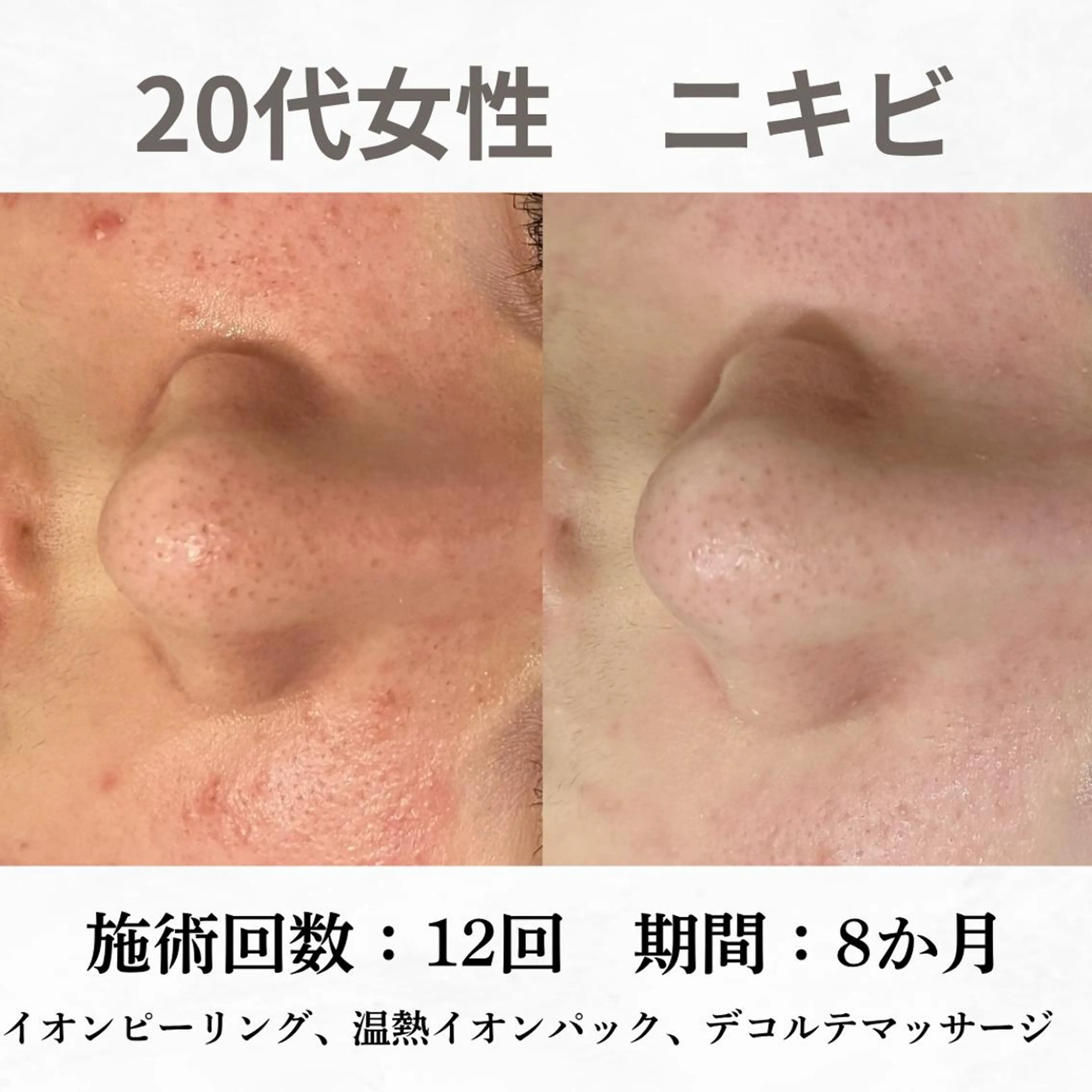 重度ニキビ専門🌷 ダウンタイムなしのエステ・リラクイメージ