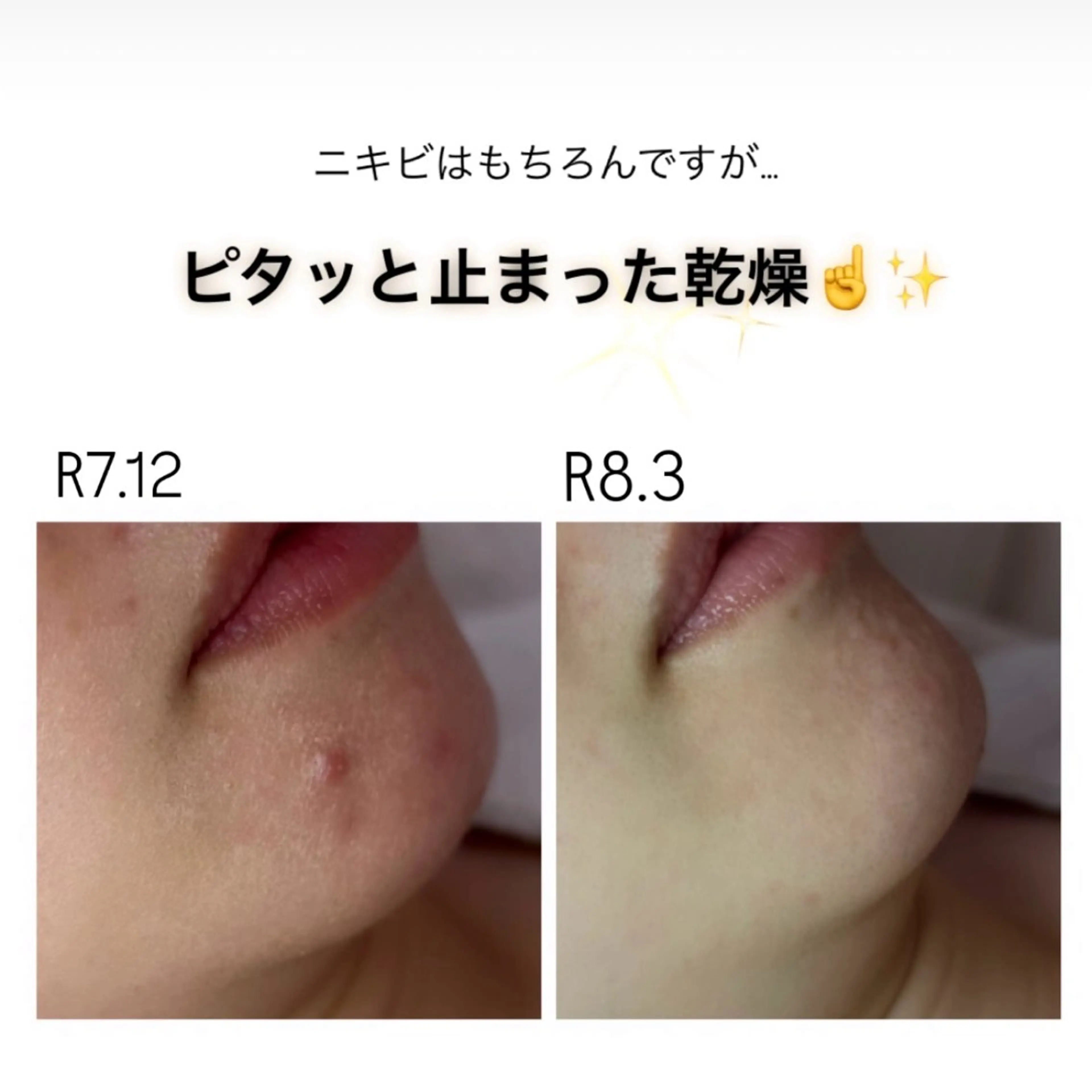 エステ ニキビ/敏感肌/乾燥 Lilyauraのエステ・リラクイメージ