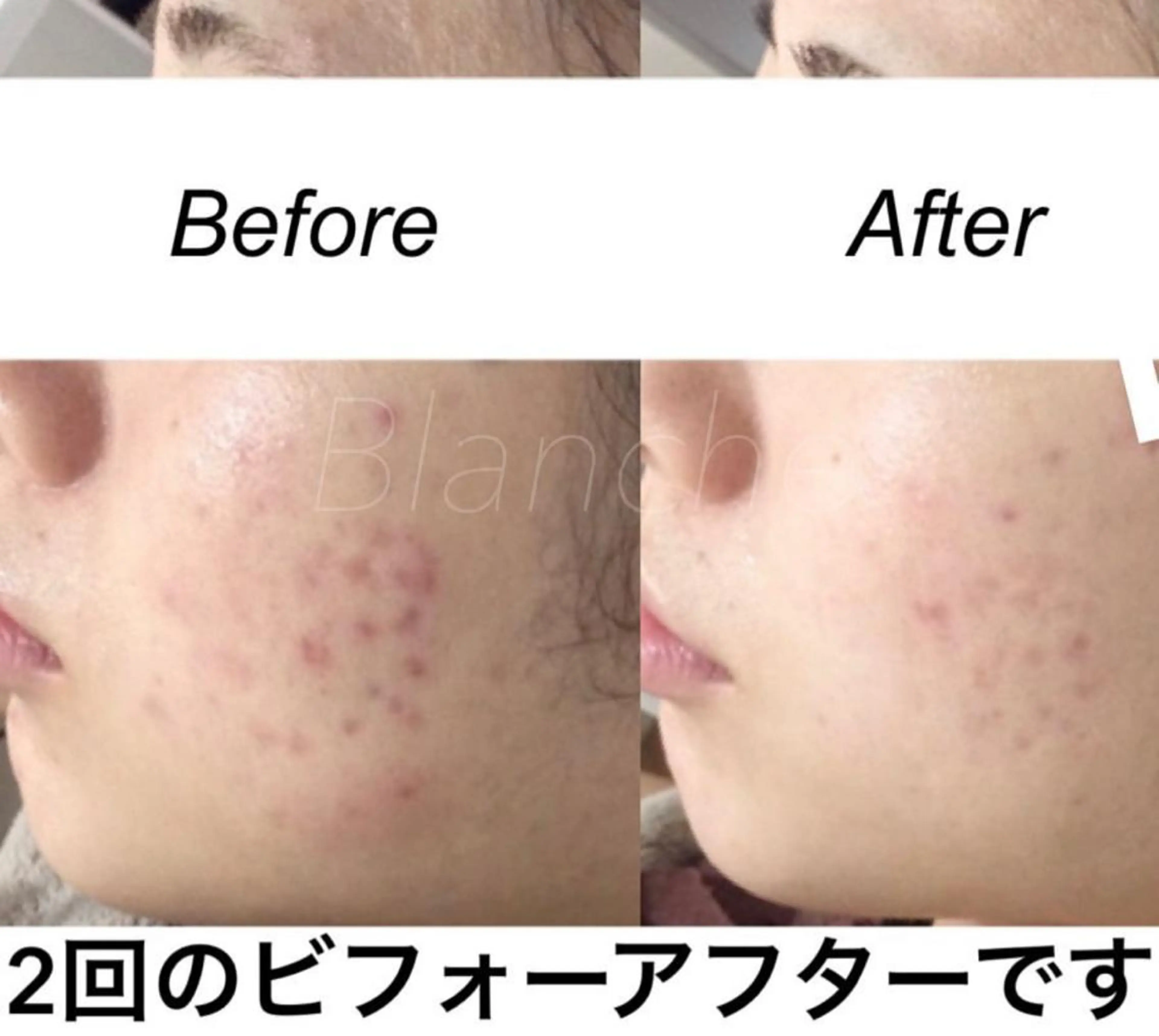 セミロング カラー パーマ ヘアアレンジ ネイル マツエク・マツパ エステ リラク 都度払い肌質改善 &脱毛Blancheのエステ・リラクイメージ