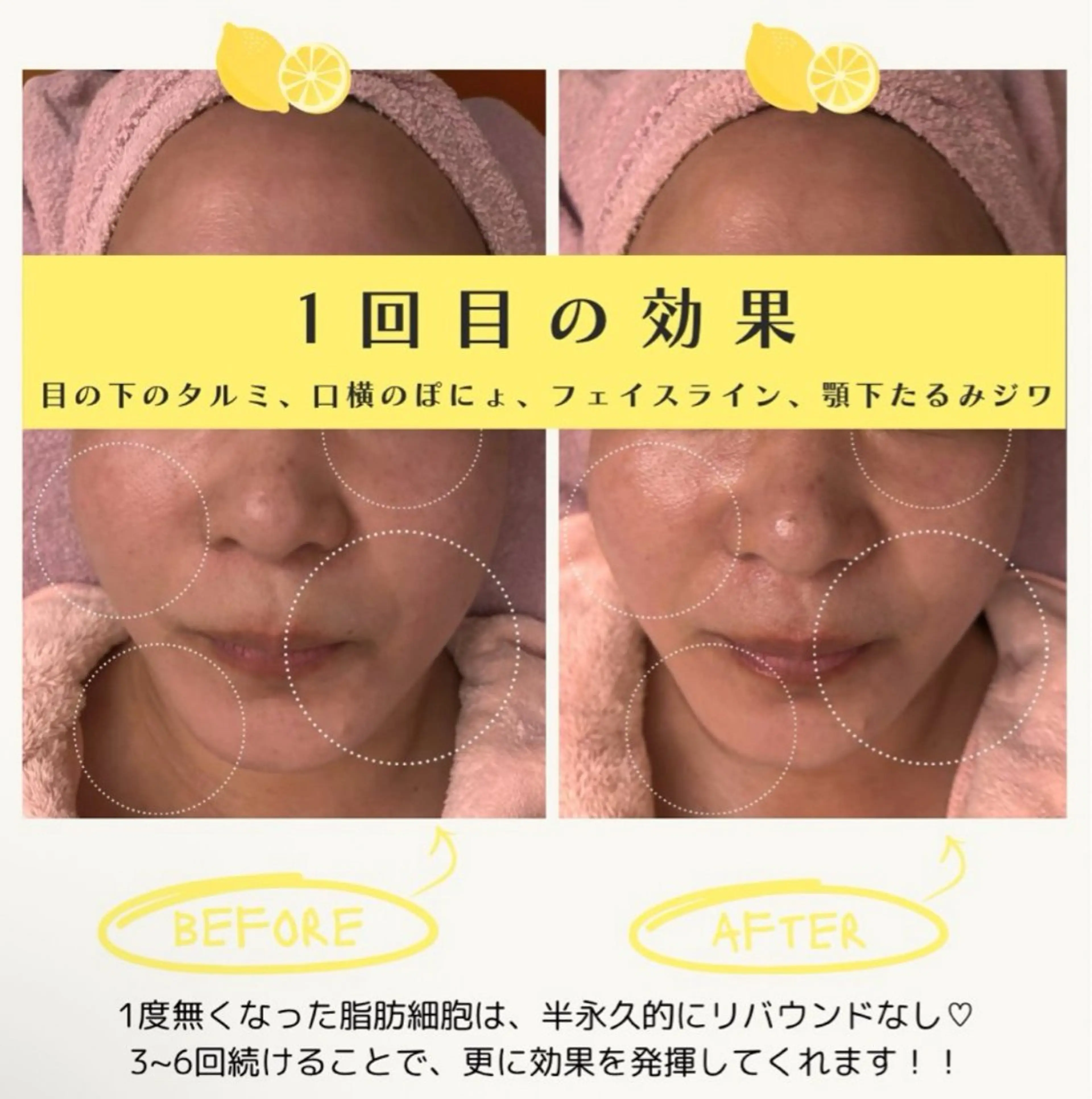 🇰🇷韓国最新🍋顔痩せ・小顔・口周りぽにょ・二重アゴなど気になる方に‼️関西最安値？！でご提供してます🫶🏻‎💕の写真