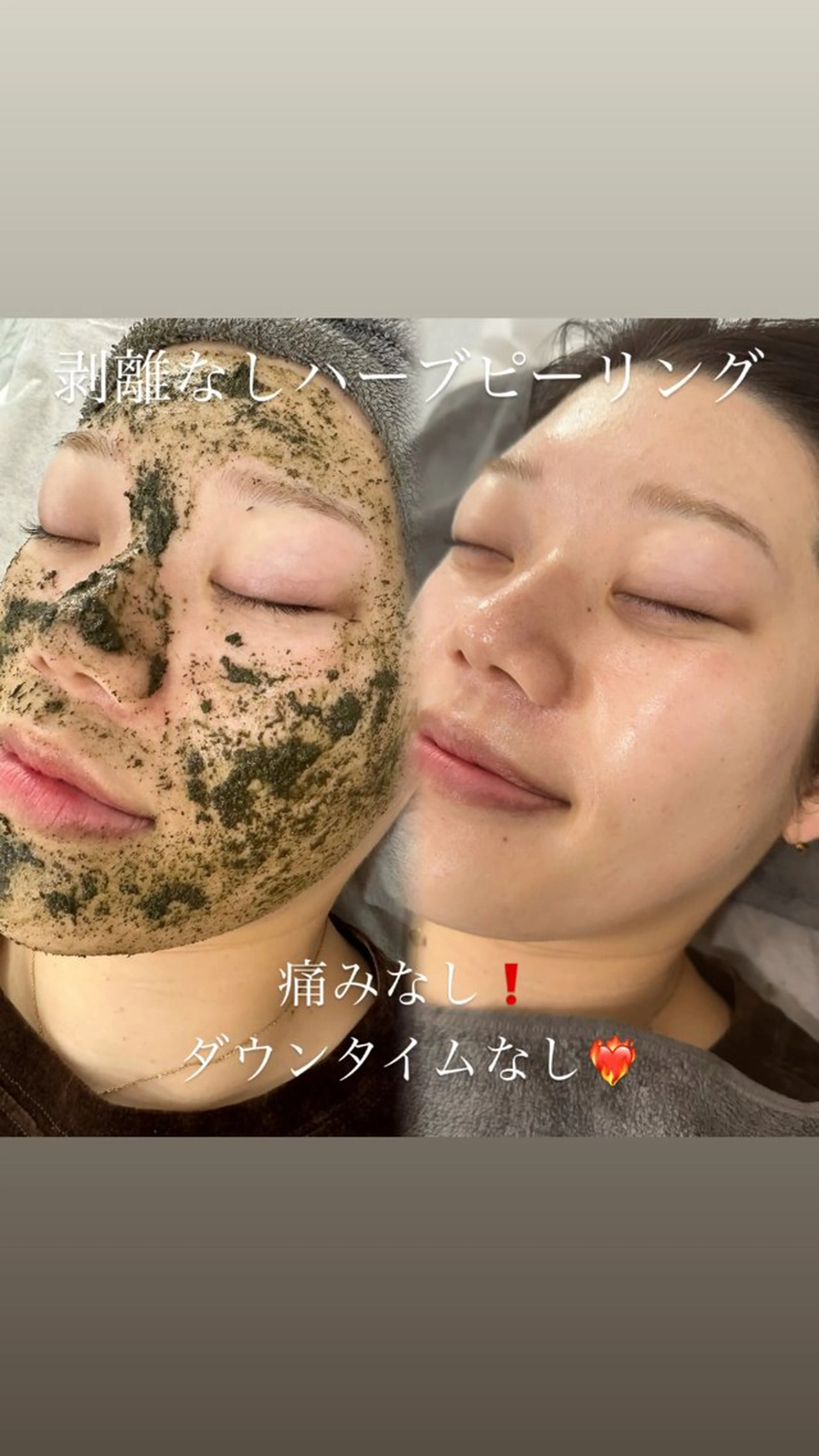 明日🈳有り♡【初回限定価格 】50％OFF‼️剥離なしハーブピーリング🌿ニキビ・毛穴悩みを根本改善🎀の写真