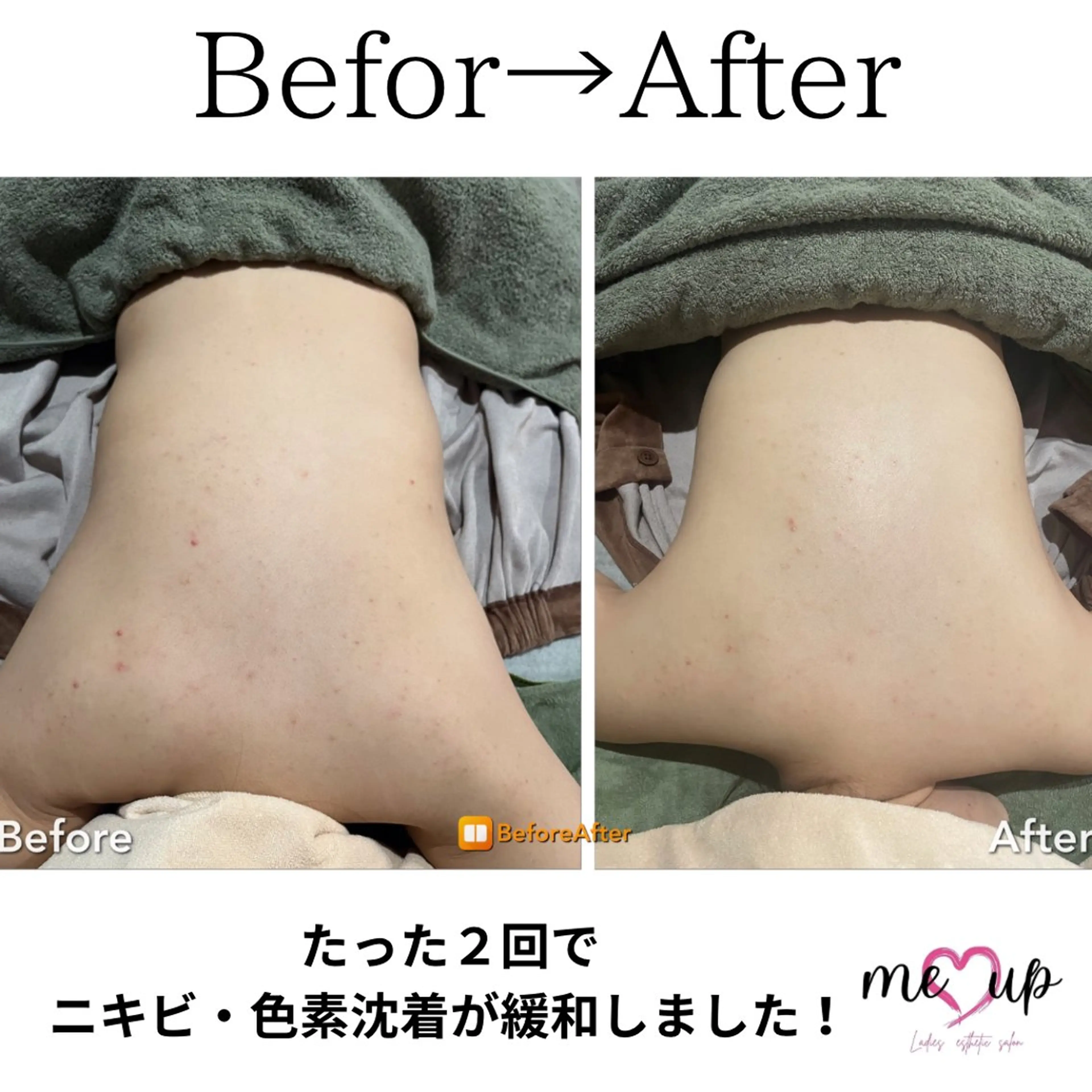 エステ Meupニキビ専門店 背中/ハーブ/肌管理のその他イメージ