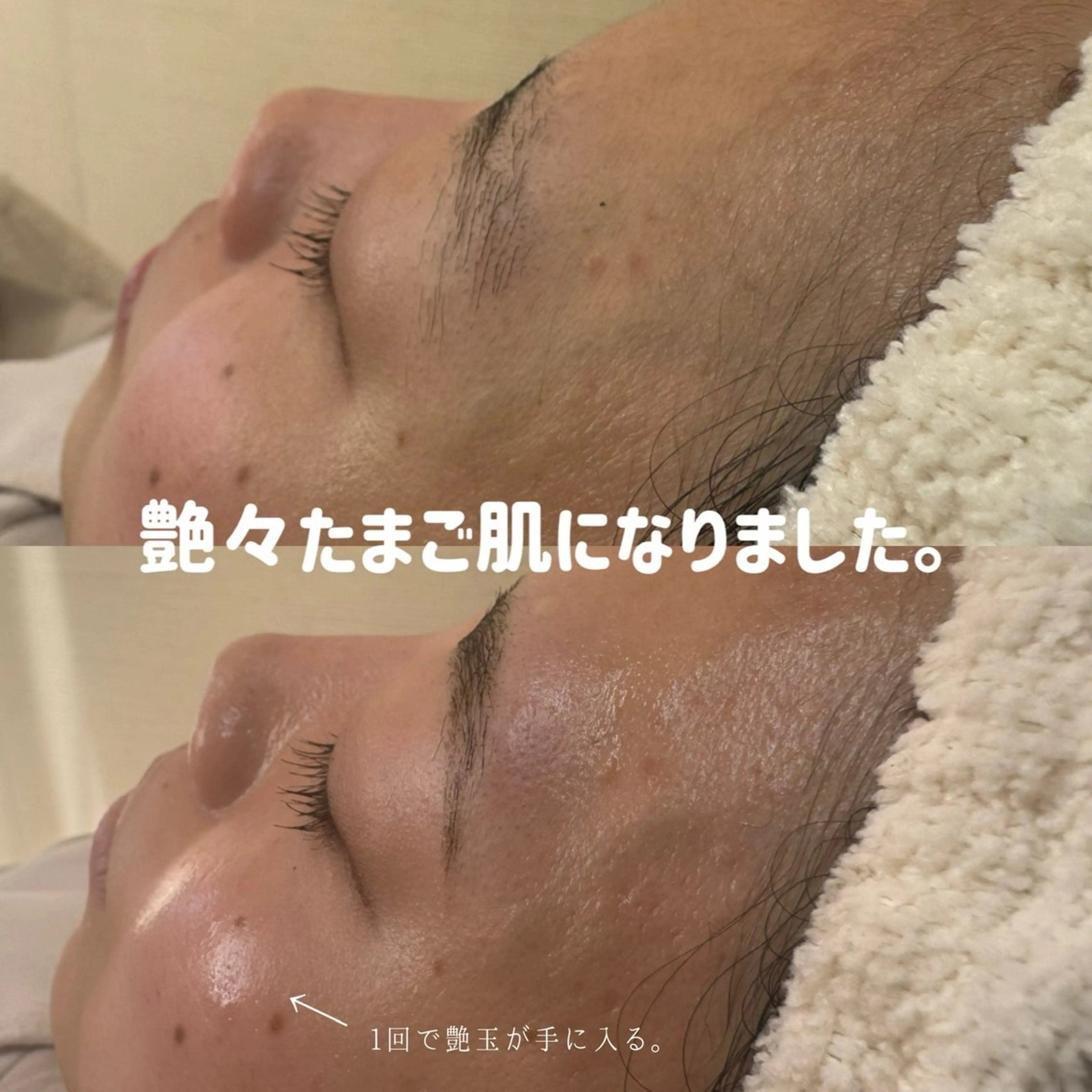 【ダイヤモンドエステ】face waxトリートメント　全顔60minの写真