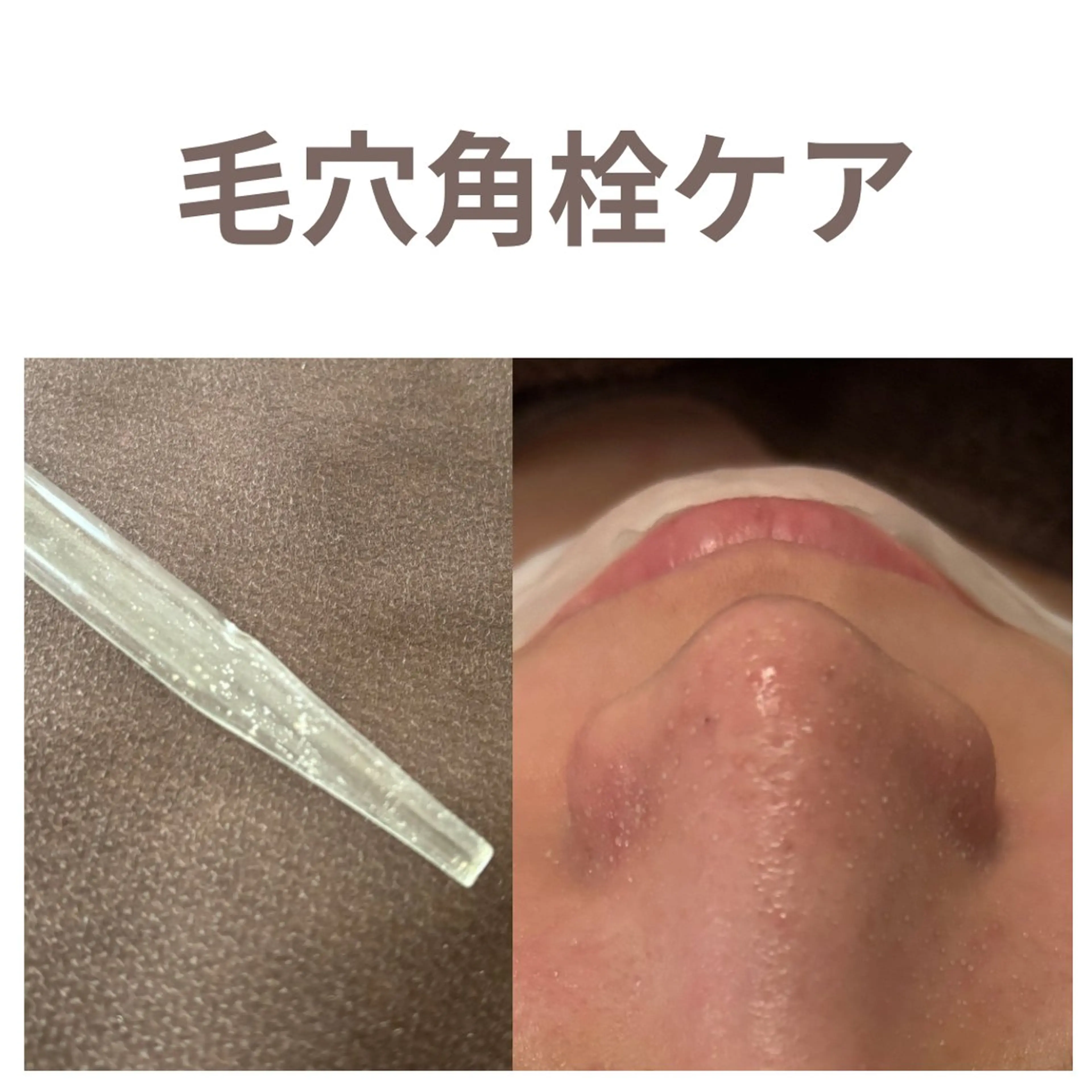 🫧毛穴クリアフェイシャル🫧角栓の詰まり・黒ずみ・ザラつきに(施術時間約45分)の写真