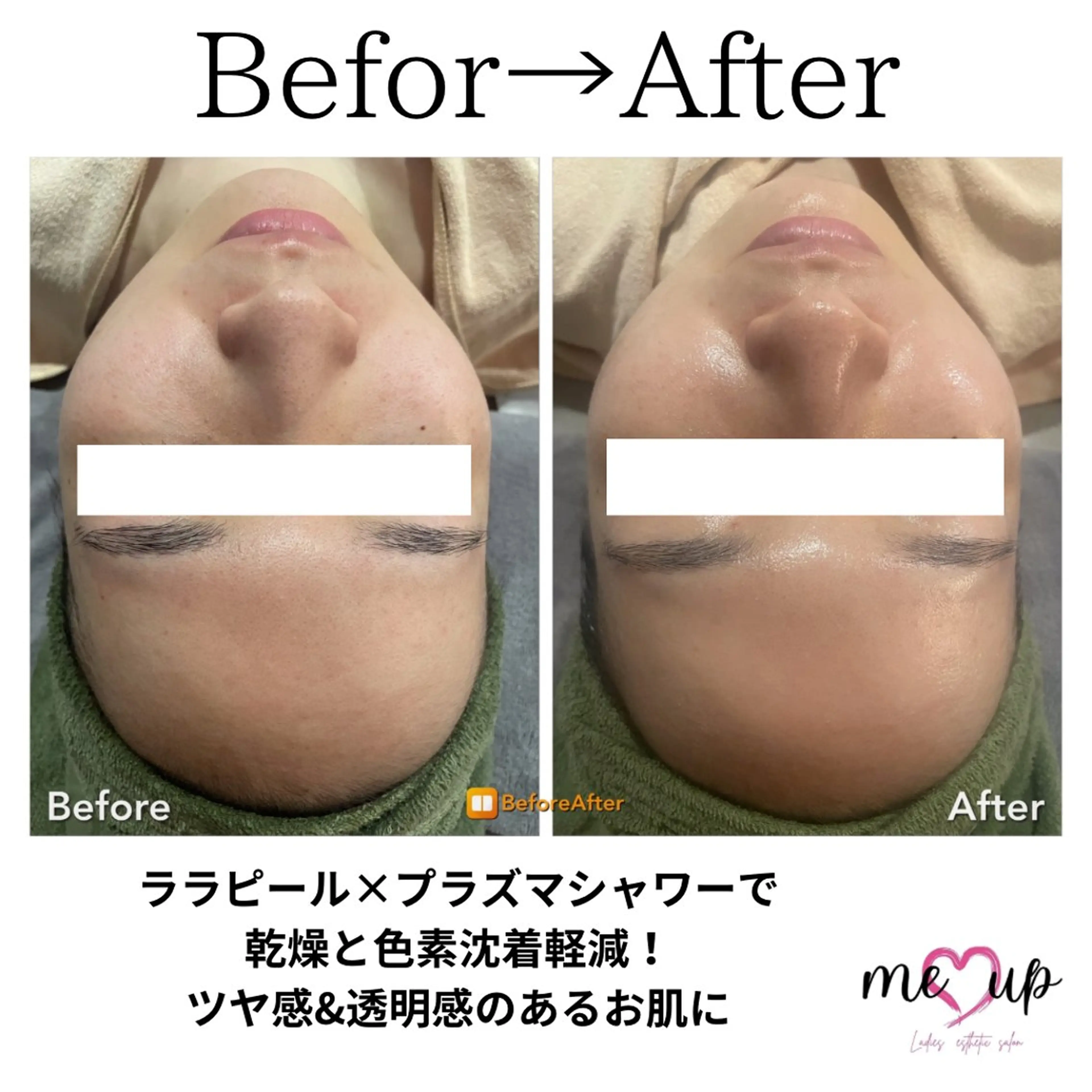 エステ Meupニキビ専門店 背中/ハーブ/肌管理のその他イメージ