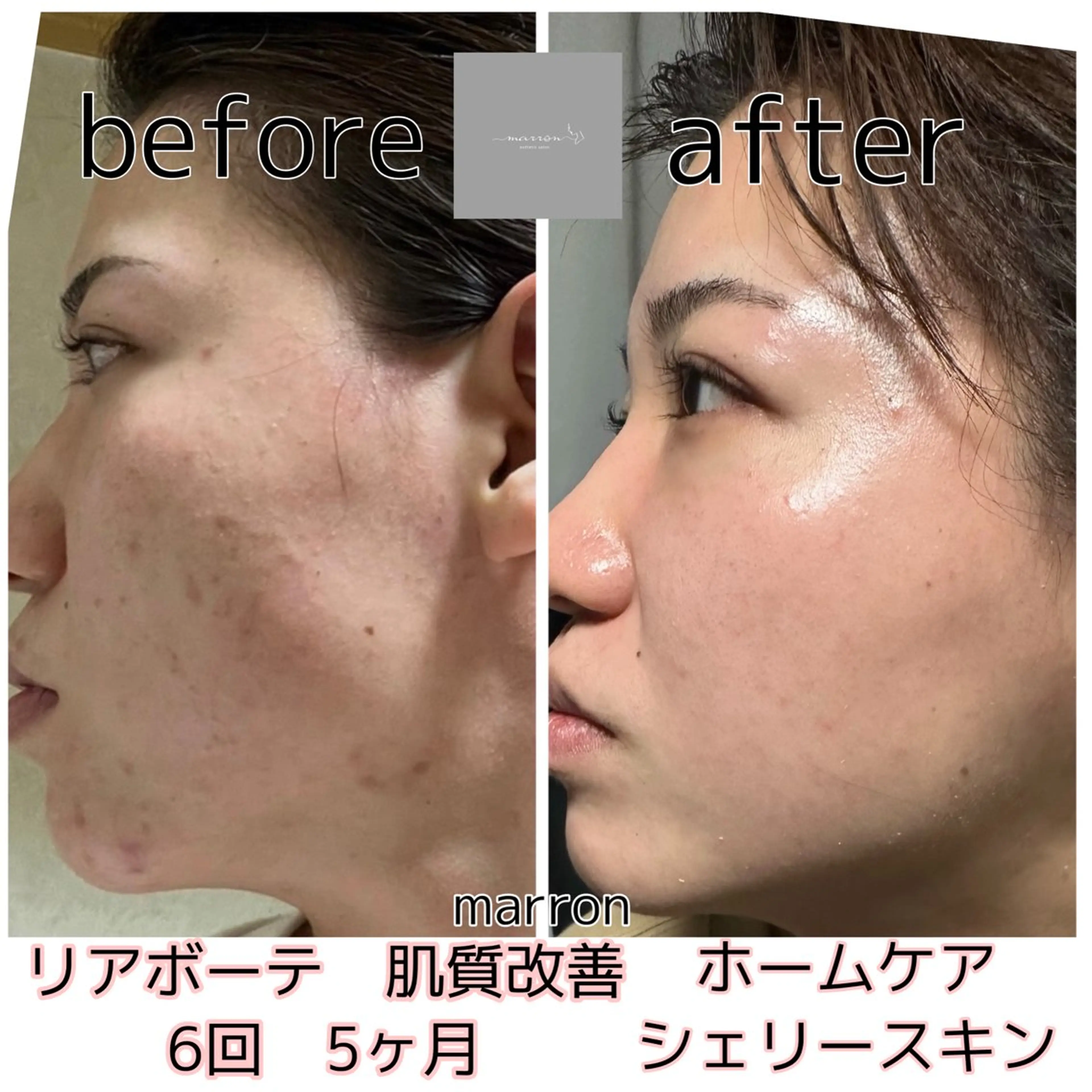 痩身ハイパーナイフ ララピールリアボーテのエステ・リラクイメージ