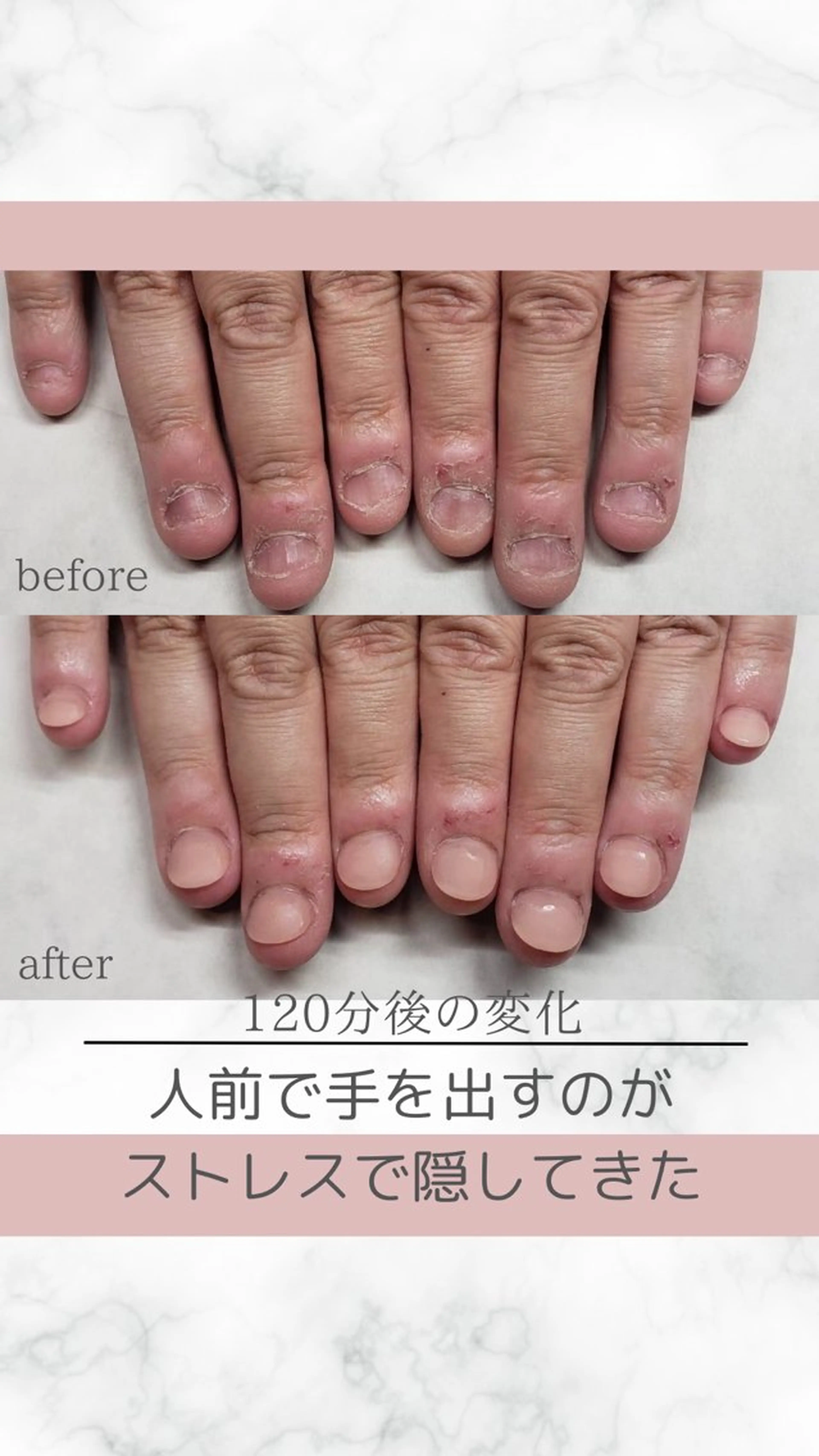 ネイル ハンドネイル ティアラネイル 宇都宮深爪矯正のネイルデザイン