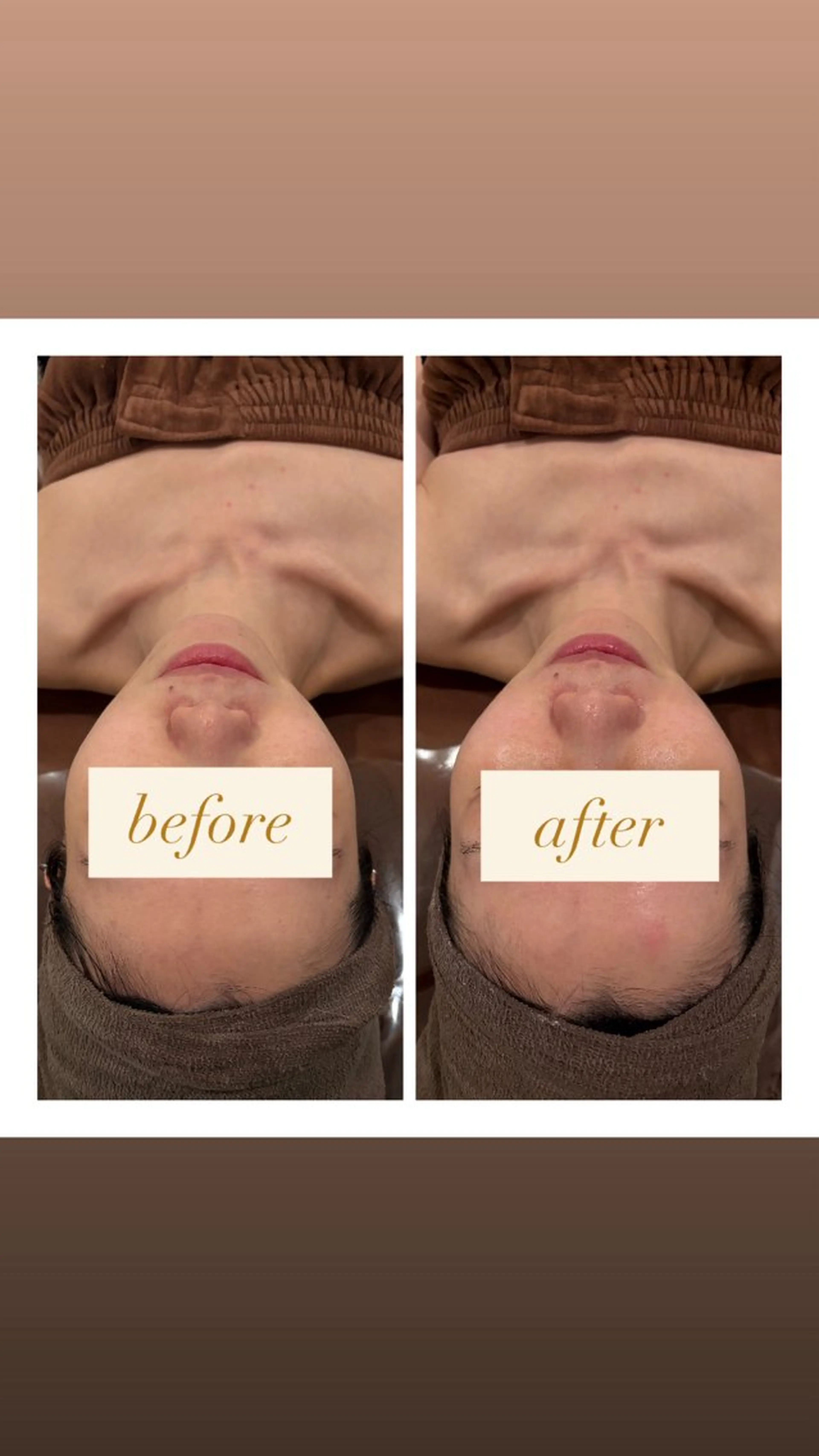 【輪郭形成コルギ🌿】圧倒的小顔の変化✅ハイパーナイフEX10分プレゼント🎁✨の写真