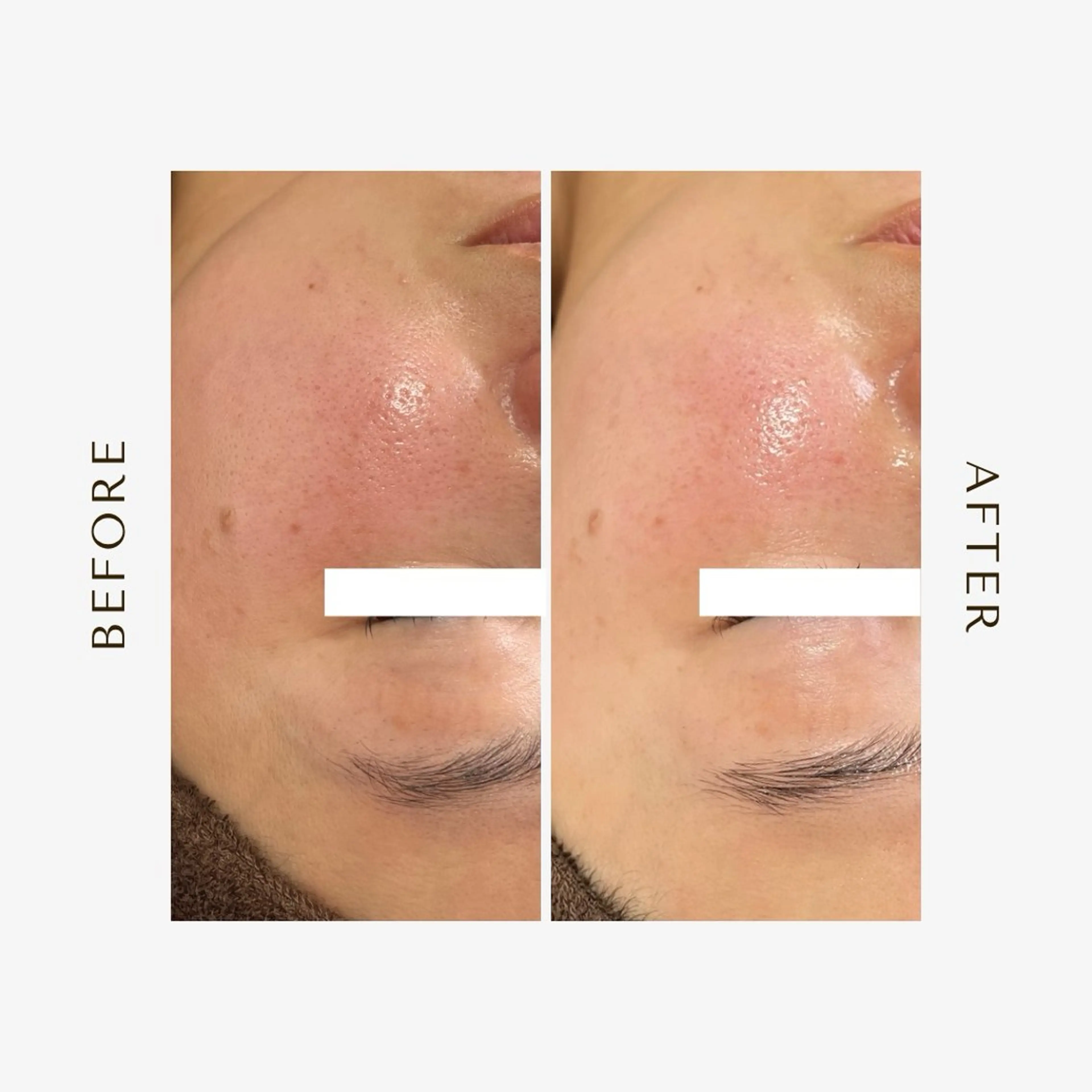 【肌再生コース】毛穴を引き締め、内側からハリとツヤを高めます✨の写真