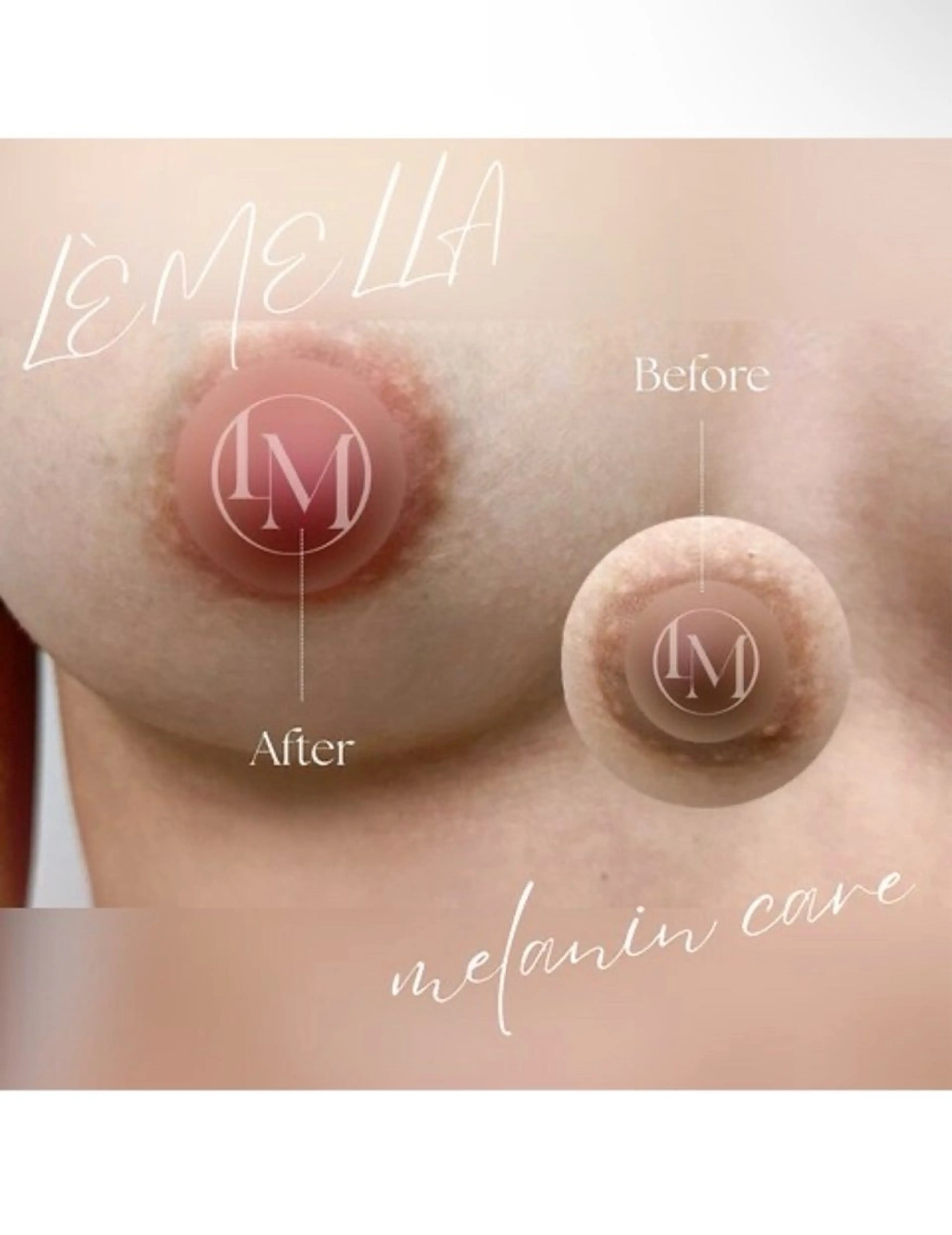 【乳輪★黒ずみケア】最新メラニン除去 ＜LEMELLA> アフタークリーム付き♪の写真