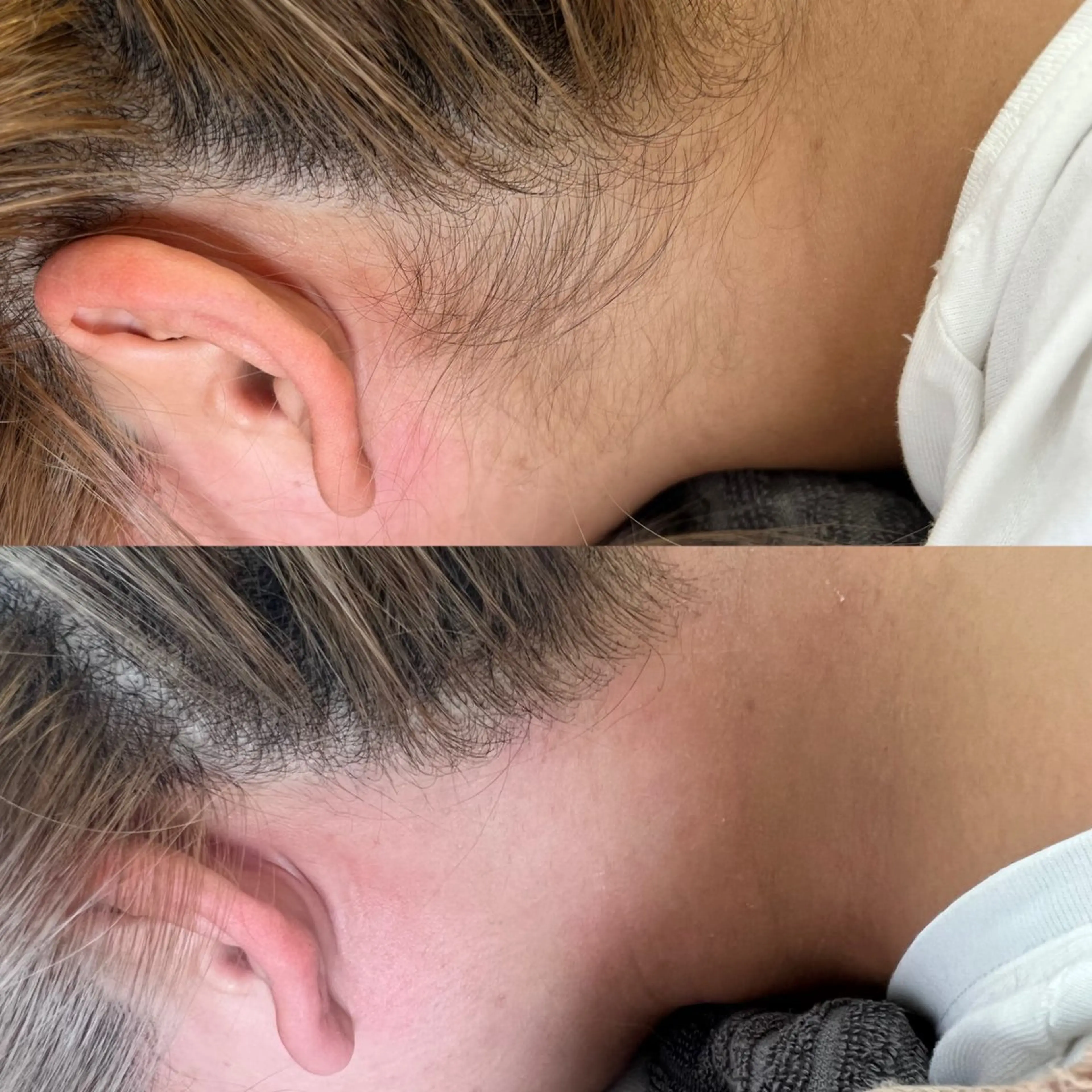 成人式前おススメ‼️襟足wax脱毛の写真