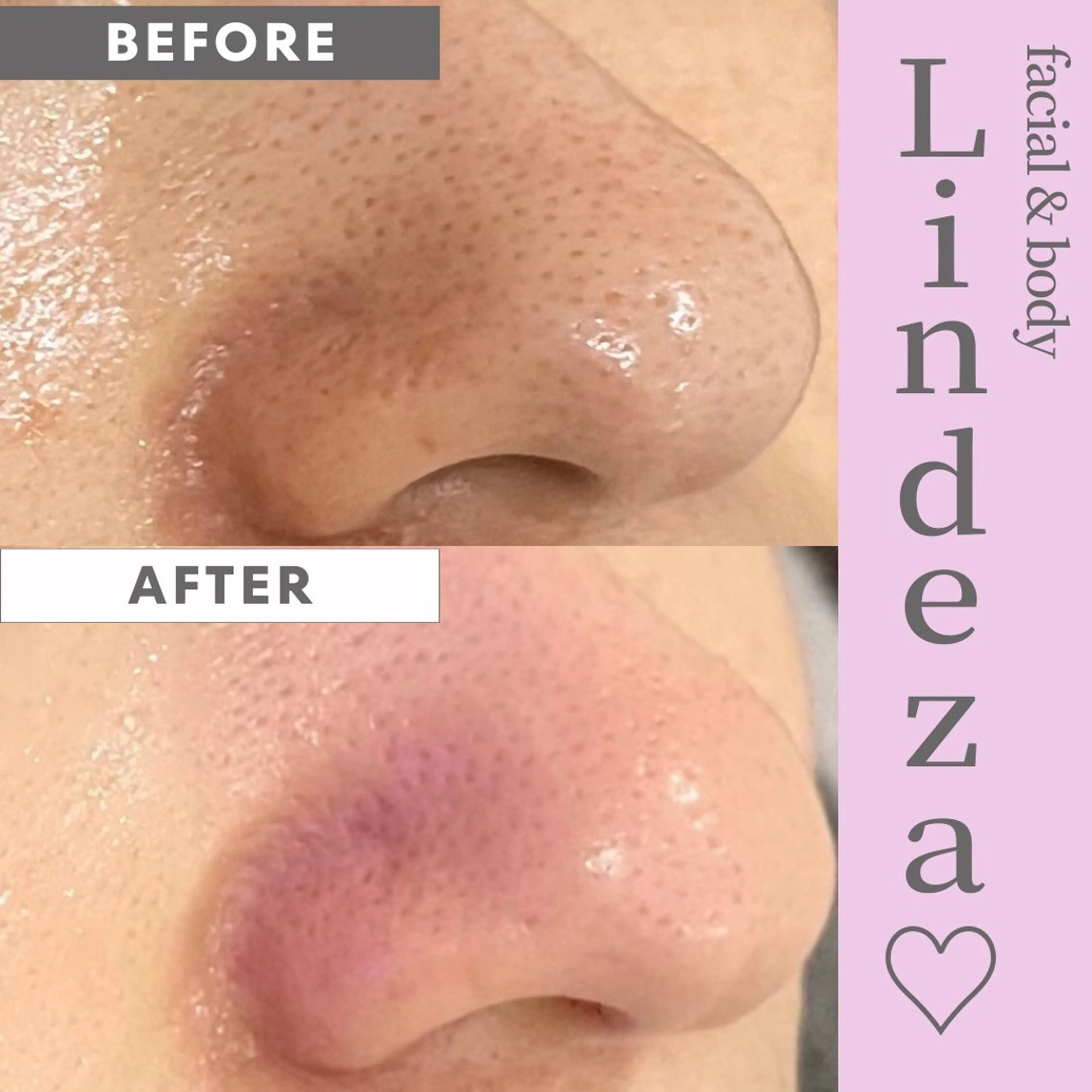 すっきり毛穴洗浄の写真