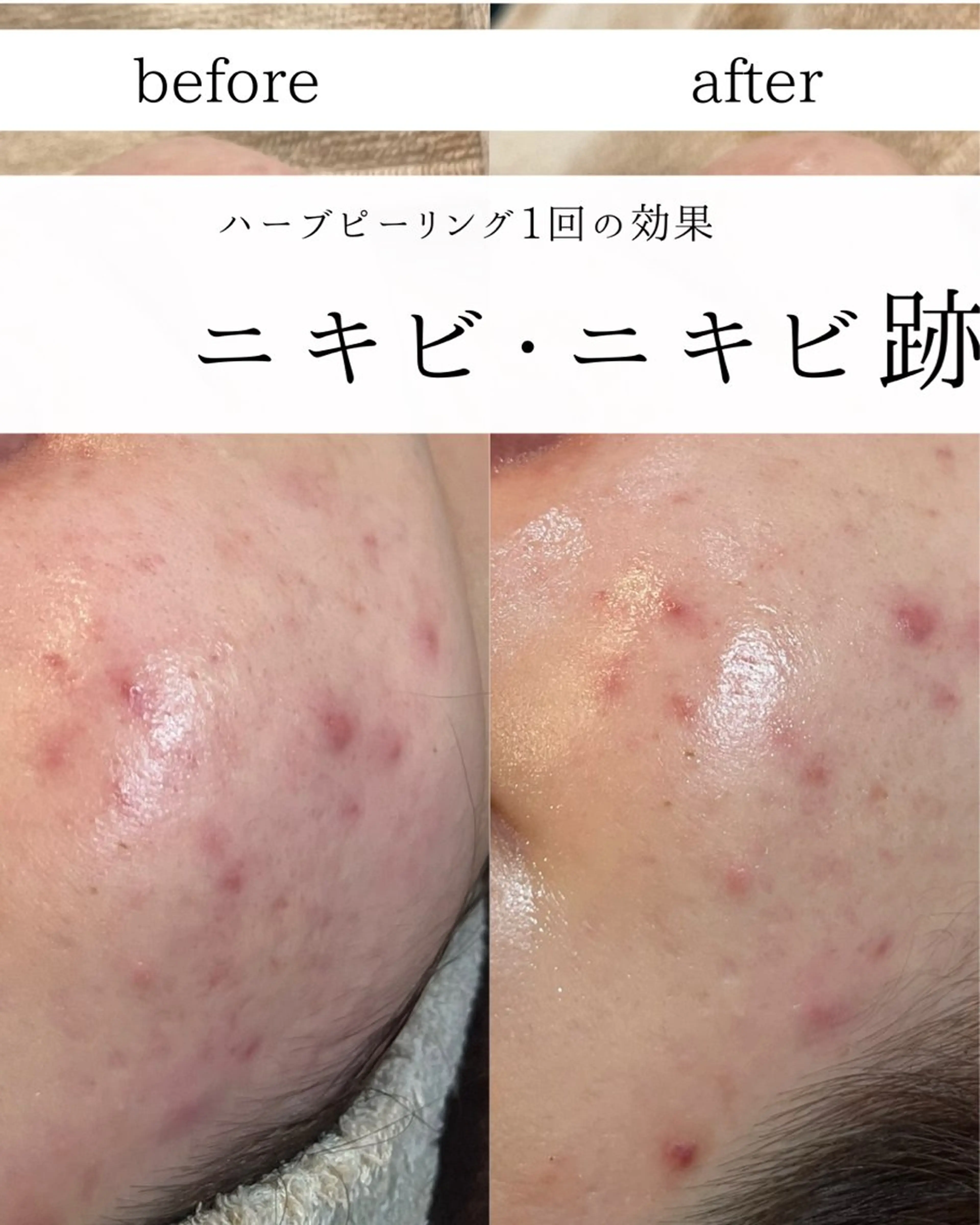 エステ yc.hacci 【ハーブピーリング】の眉毛・アイブロウイメージ