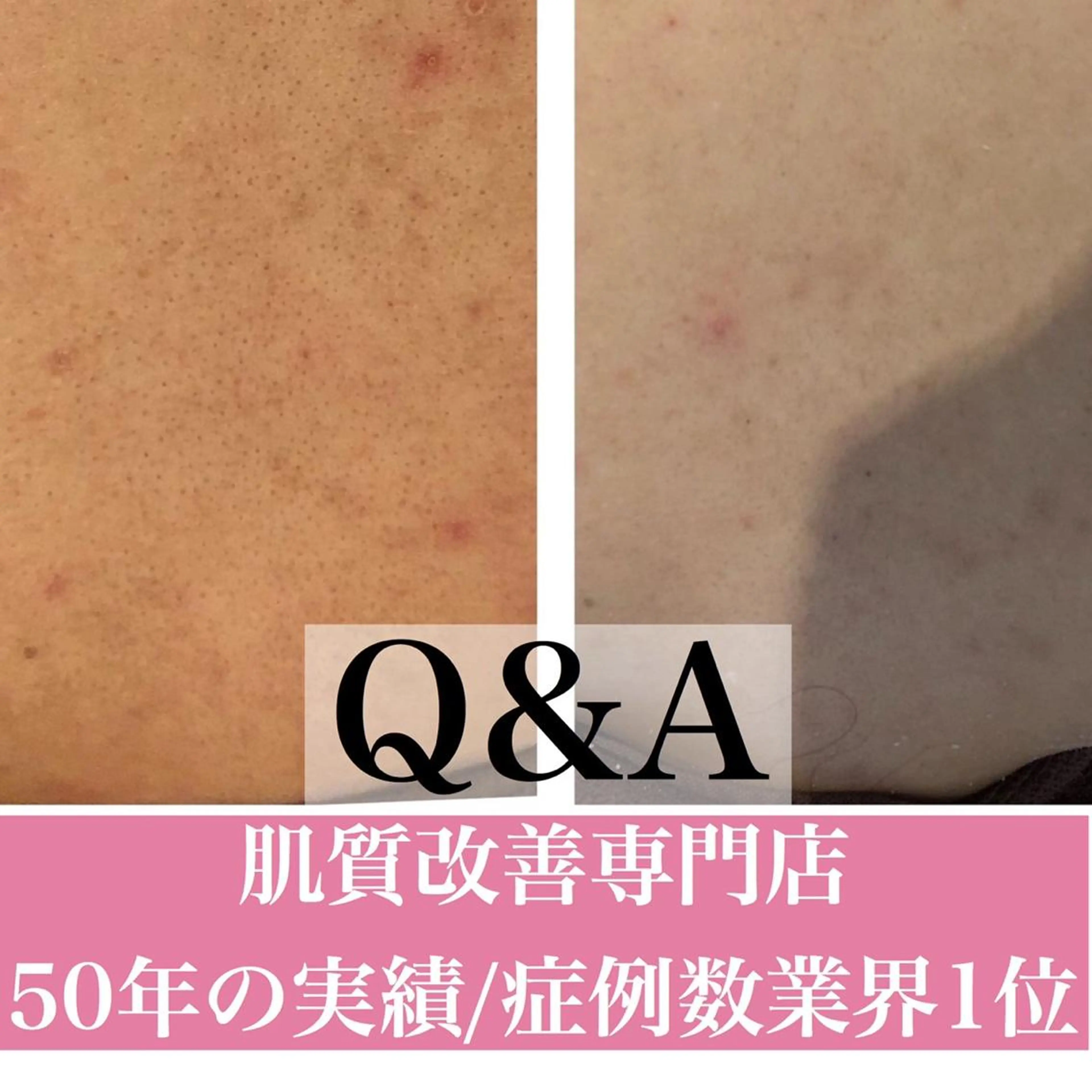 ミディアム カラー パーマ ヘアアレンジ メンズ キッズ ネイル マツエク・マツパ 学生（メンズ向け） 学生 エステ リラク ニキビ・肌質改善専門 ♡人生が変わるサロンのエステ・リラクイメージ